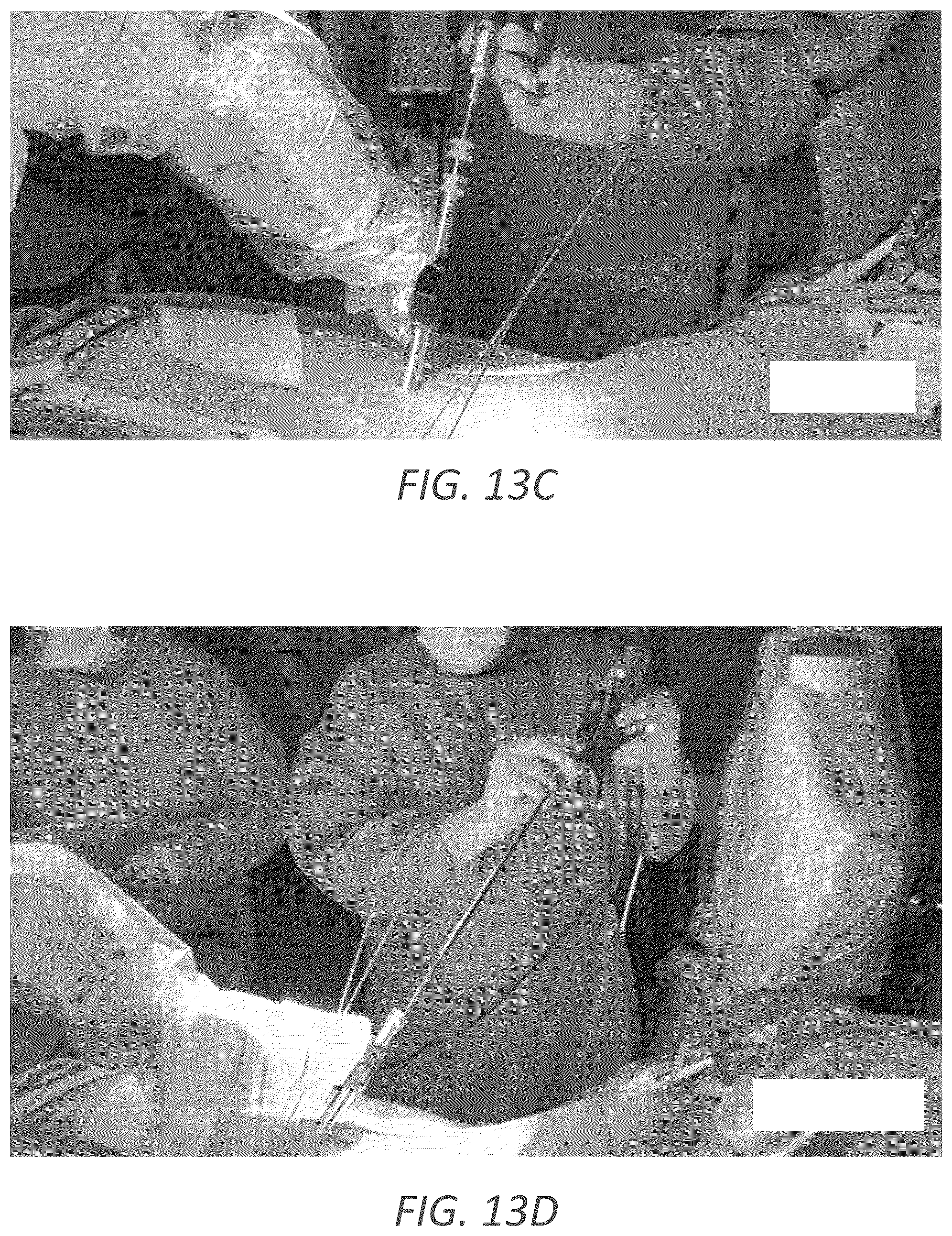 Patent US12569352 Figure 16 – Minimally invasive robotic assisted trans-facet lumbar interbody fusion