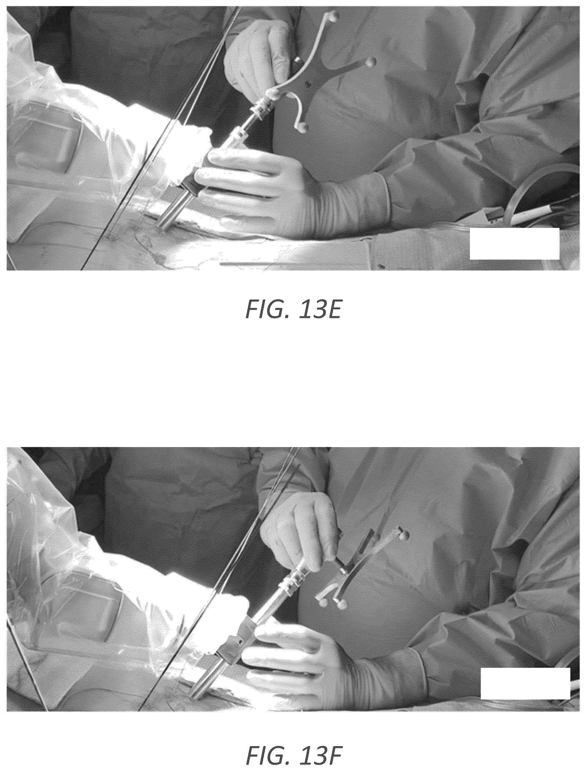 Patent US12569352 Figure 17 – Minimally invasive robotic assisted trans-facet lumbar interbody fusion