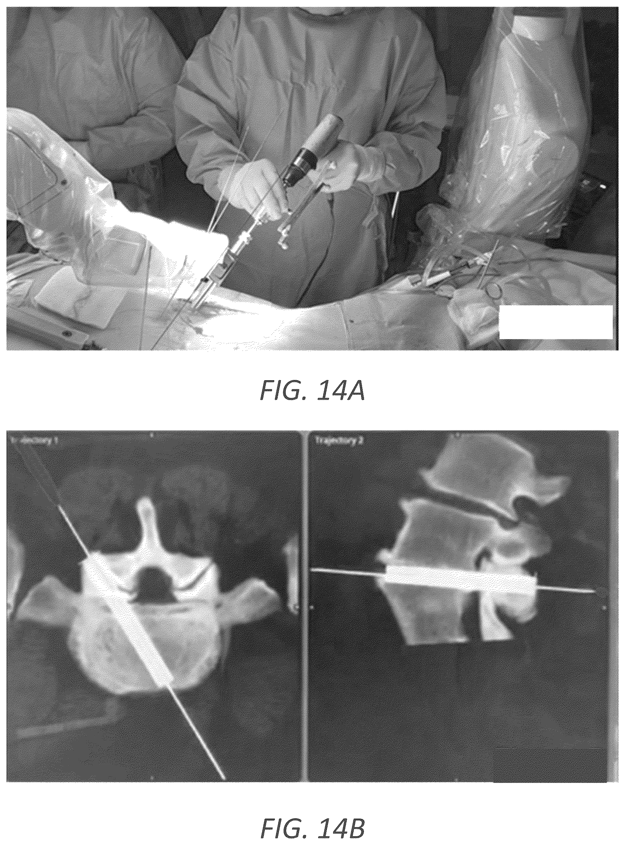 Patent US12569352 Figure 18 – Minimally invasive robotic assisted trans-facet lumbar interbody fusion