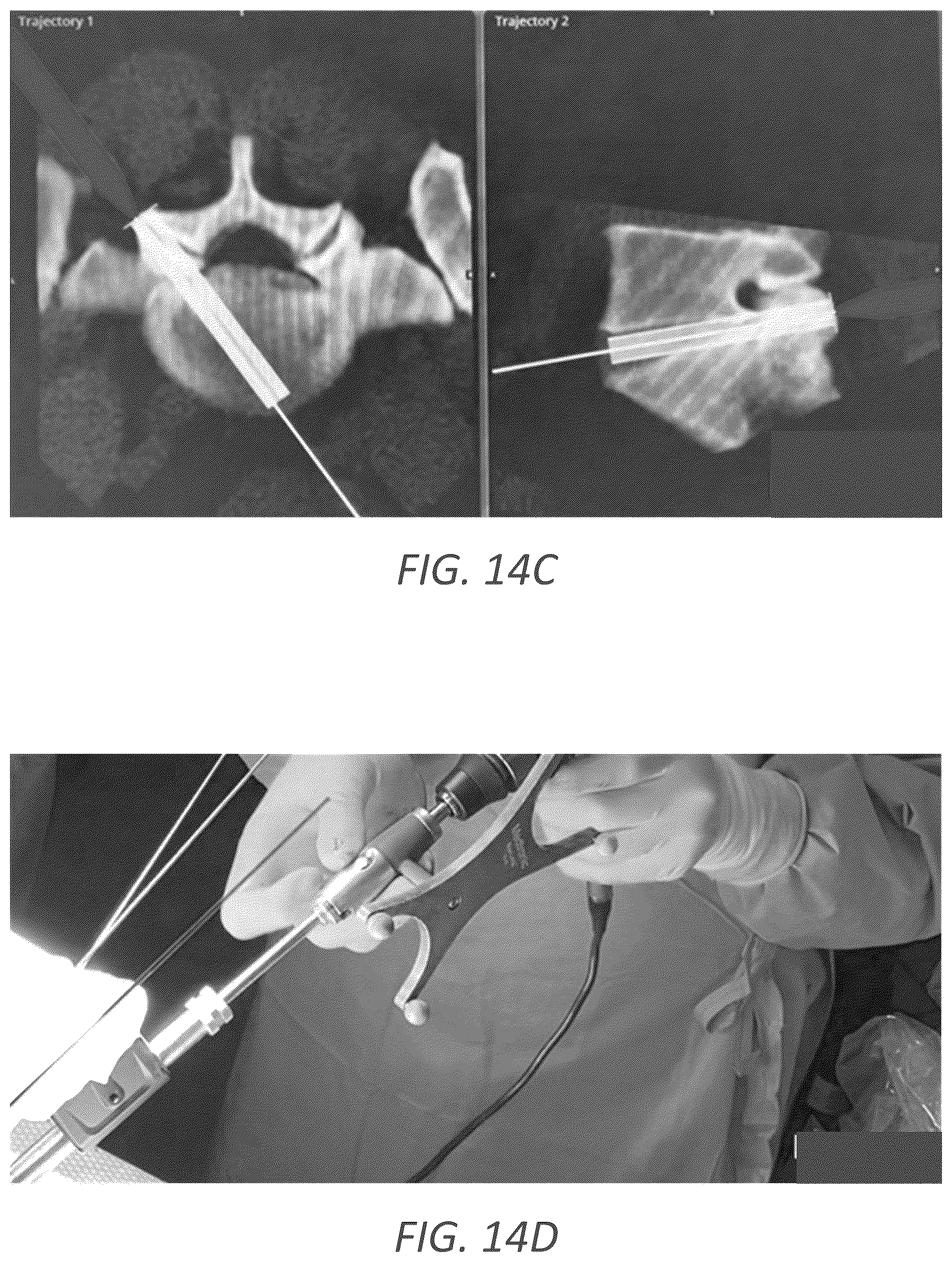 Patent US12569352 Figure 19 – Minimally invasive robotic assisted trans-facet lumbar interbody fusion