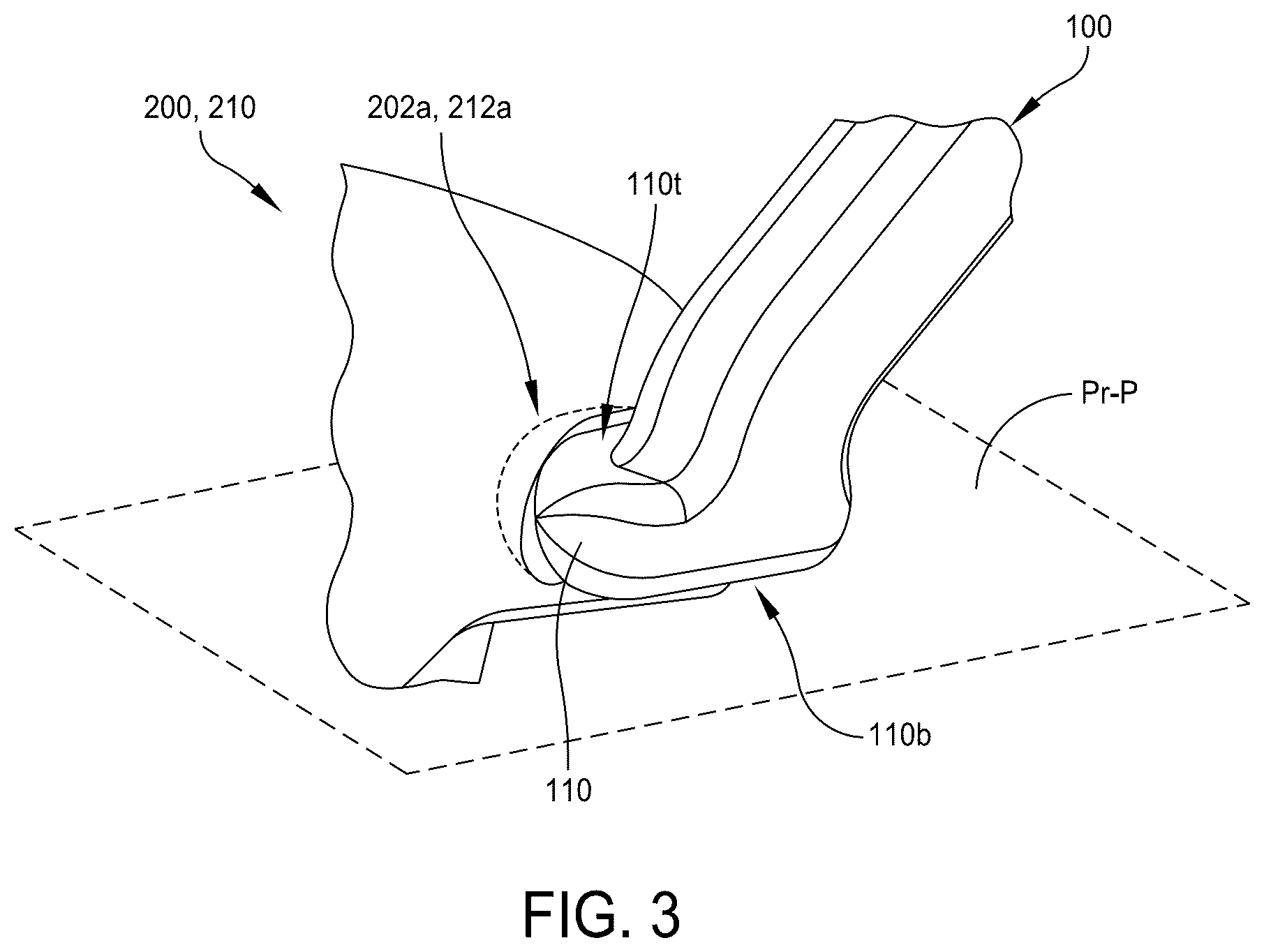 Patent US12569355 Figure 3 – Systems and methods for total ankle arthroplasty