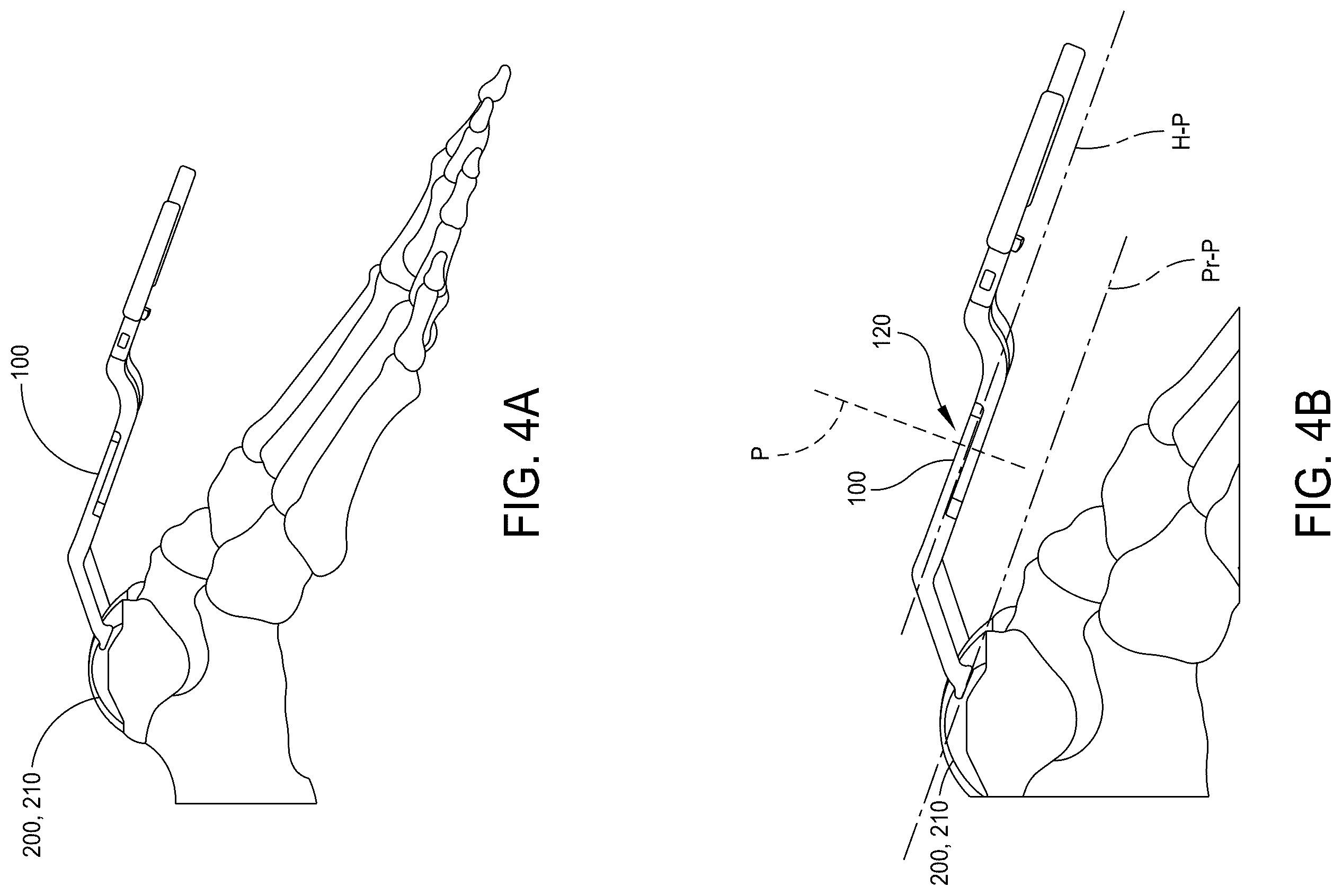 Patent US12569355 Figure 4 – Systems and methods for total ankle arthroplasty