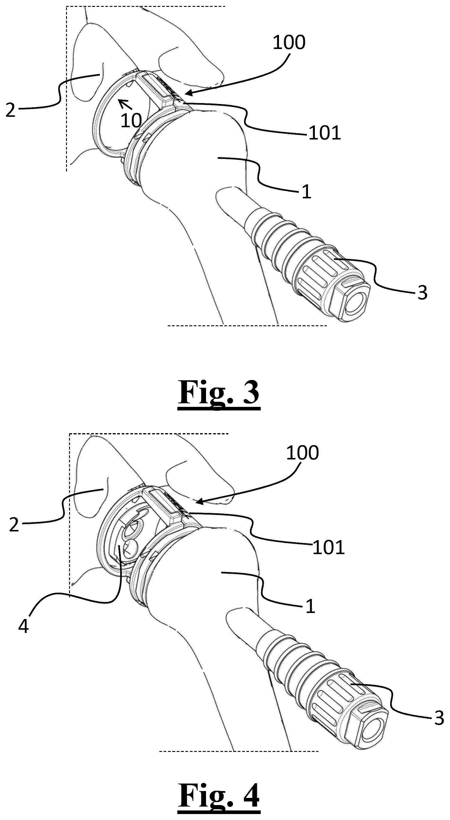 Patent US12569356 Figure 2 – Surgical spacer device for a joint
