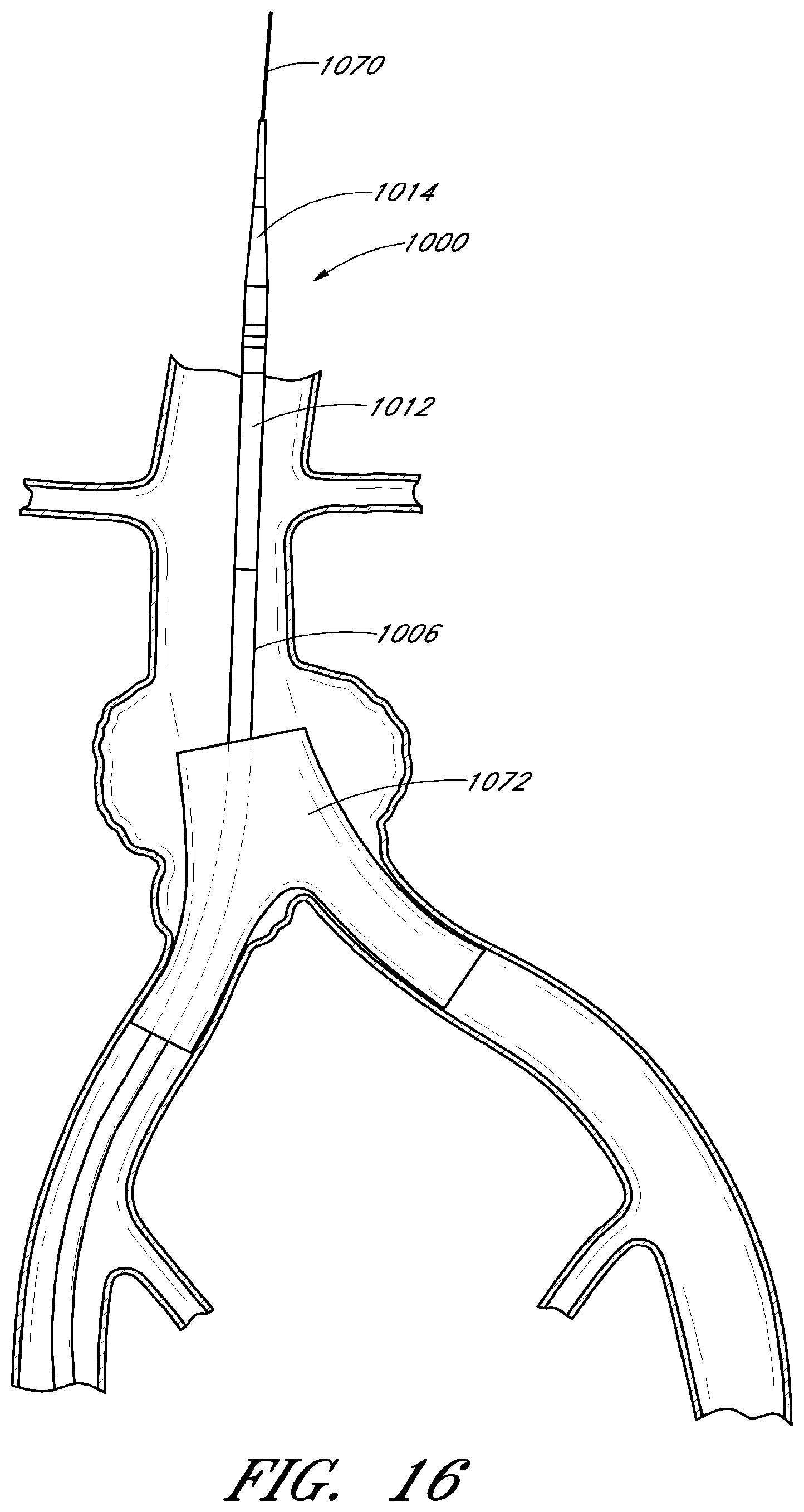Patent US12569360 Figure 13 – Apparatus and method of placement of a graft or graft system