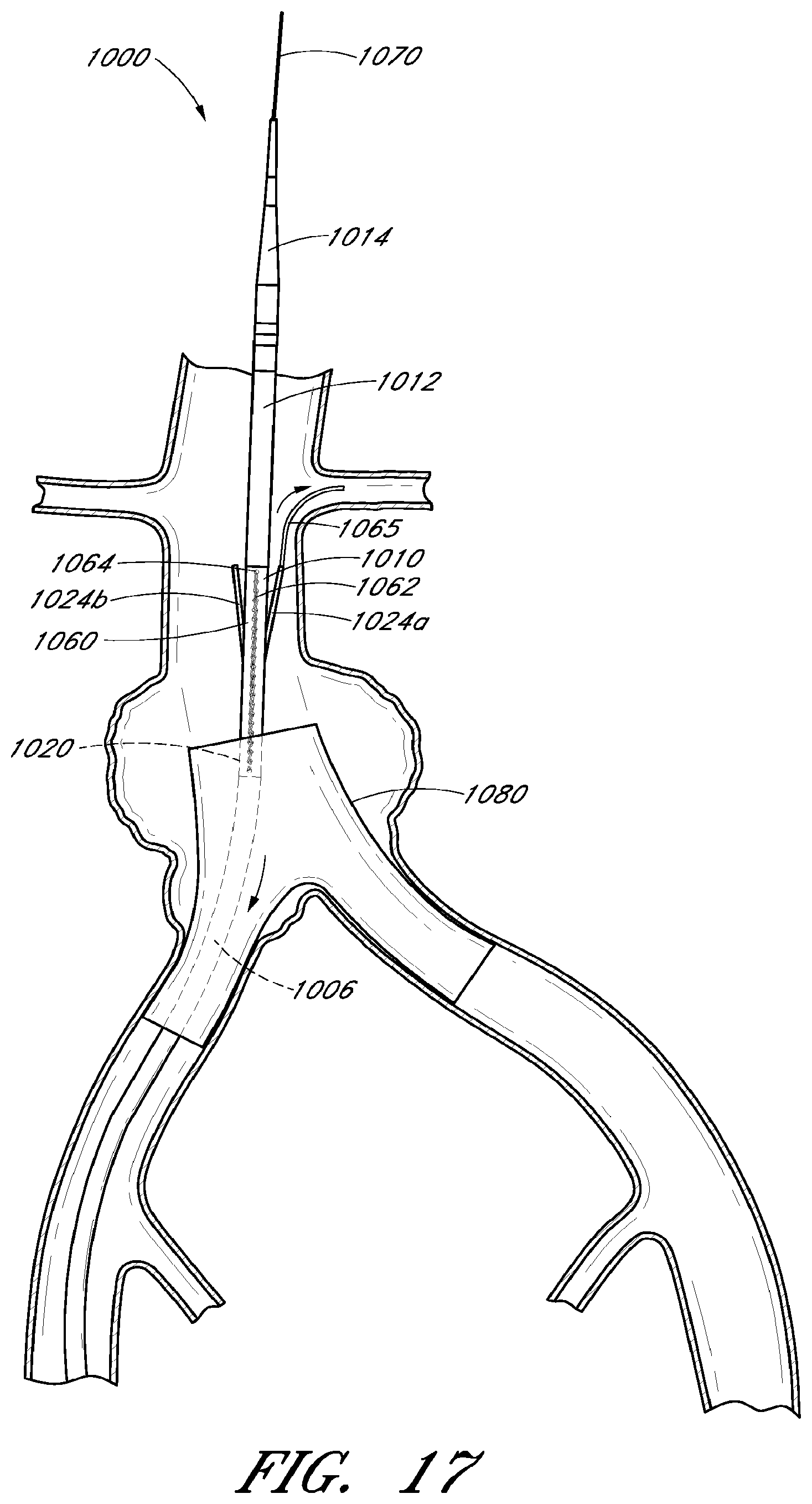 Patent US12569360 Figure 14 – Apparatus and method of placement of a graft or graft system