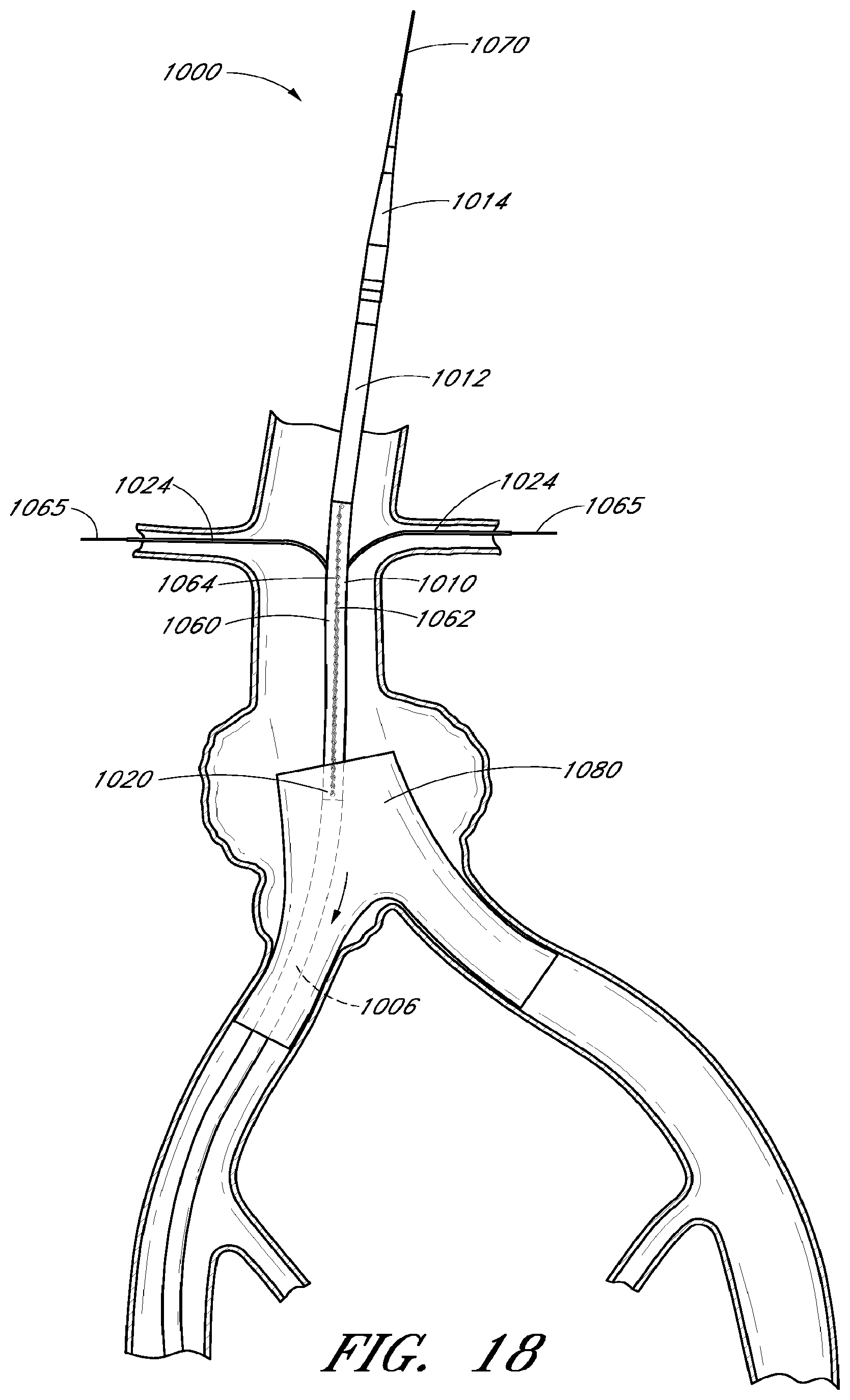 Patent US12569360 Figure 15 – Apparatus and method of placement of a graft or graft system