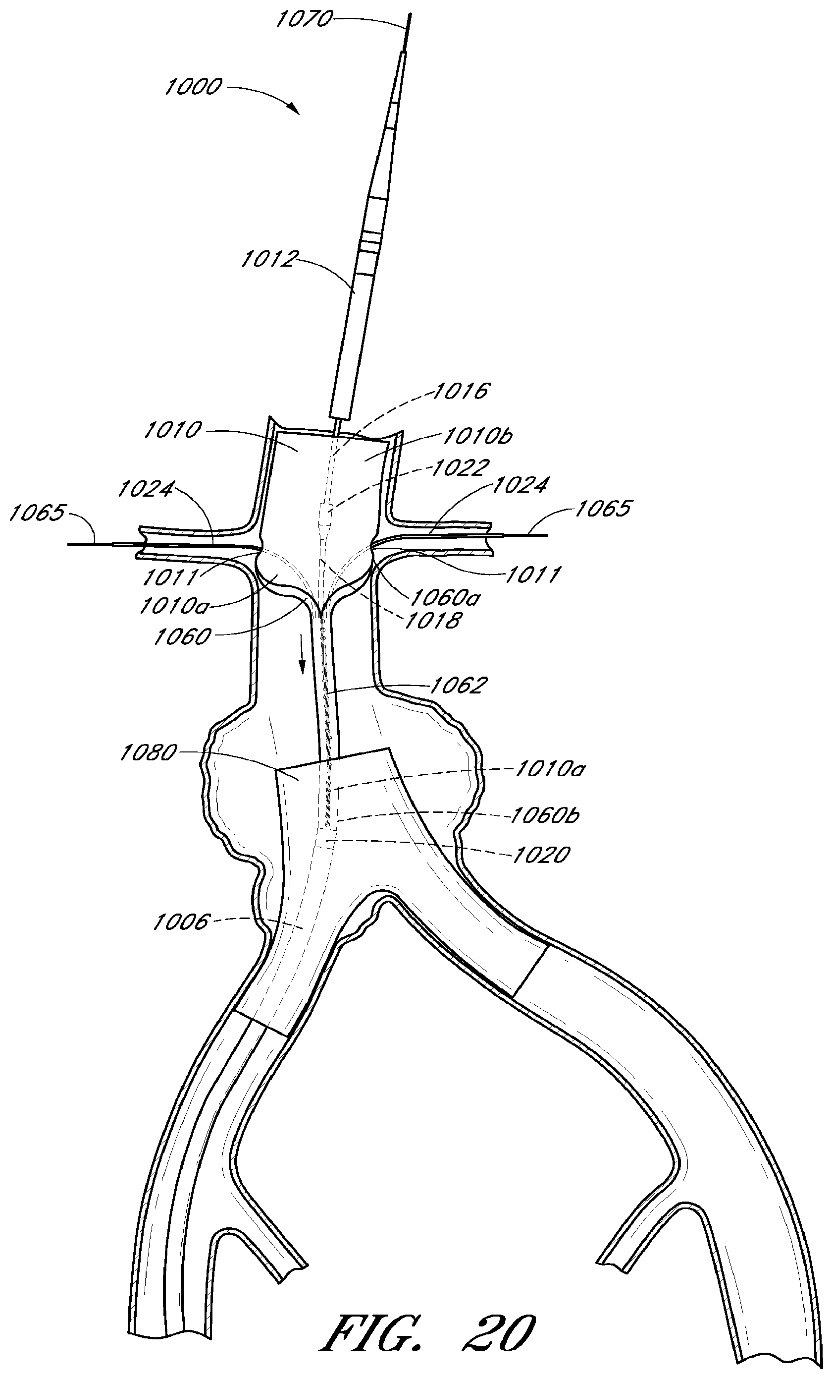 Patent US12569360 Figure 17 – Apparatus and method of placement of a graft or graft system