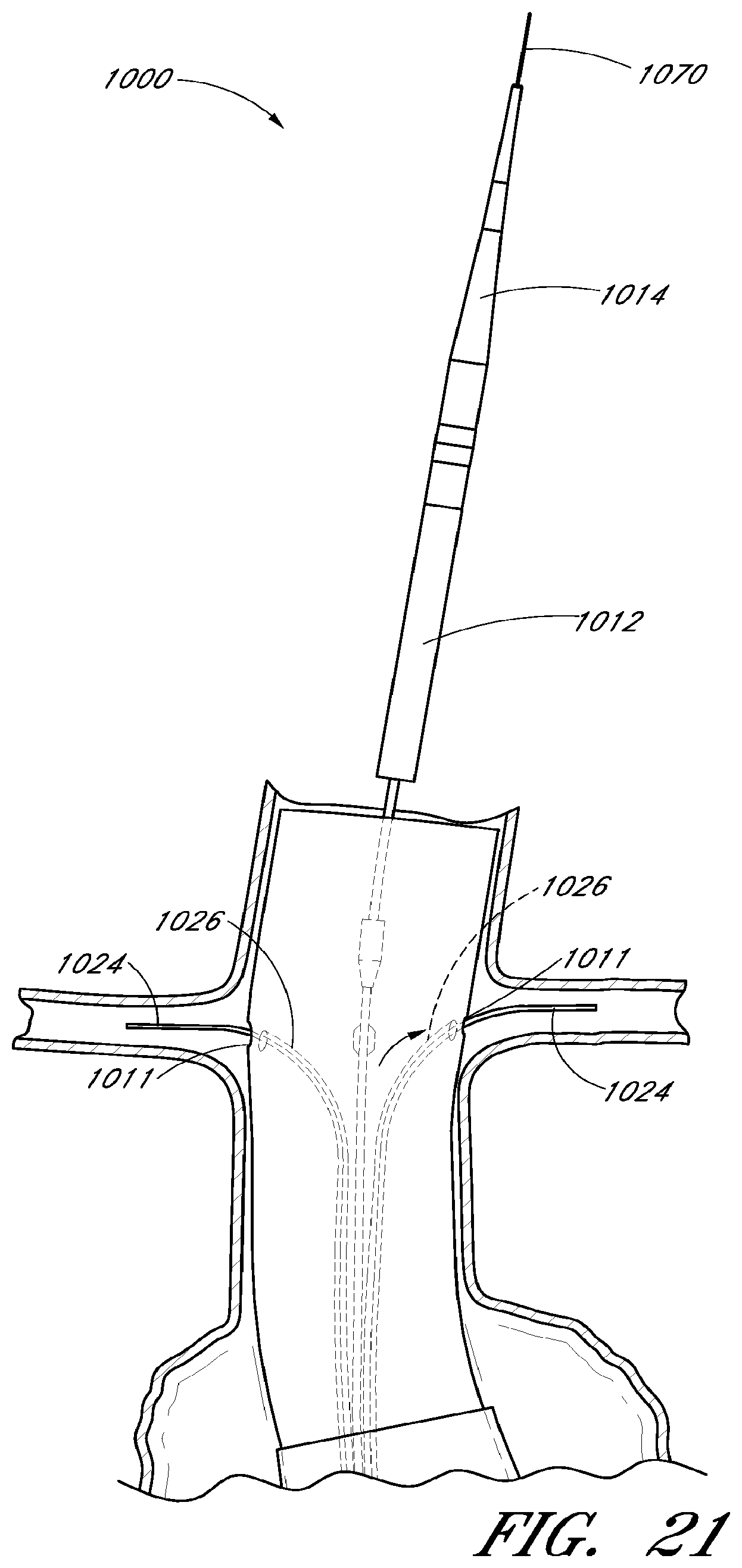 Patent US12569360 Figure 18 – Apparatus and method of placement of a graft or graft system