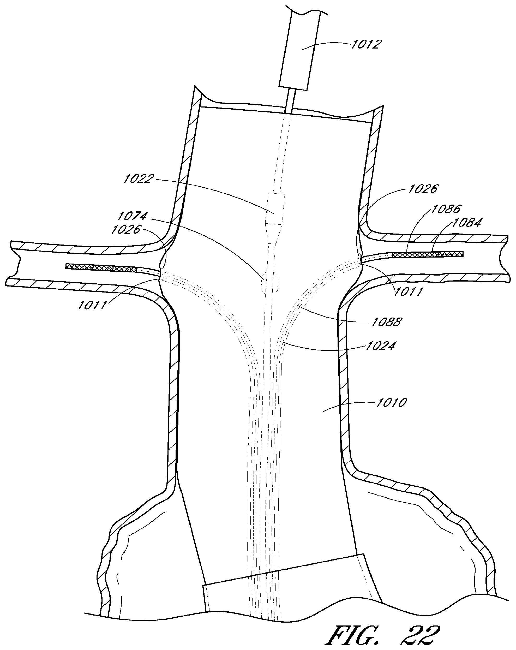 Patent US12569360 Figure 19 – Apparatus and method of placement of a graft or graft system