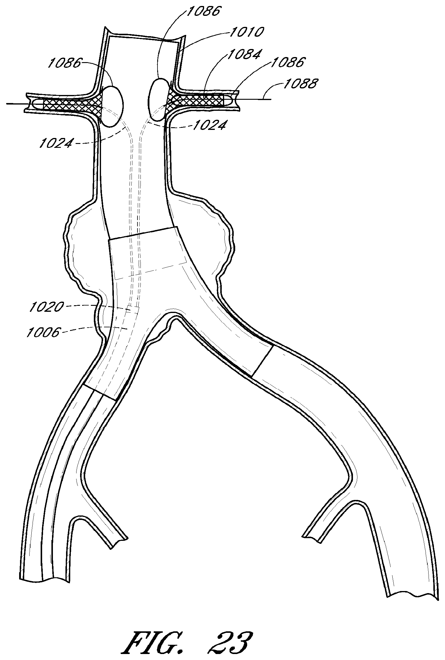 Patent US12569360 Figure 20 – Apparatus and method of placement of a graft or graft system
