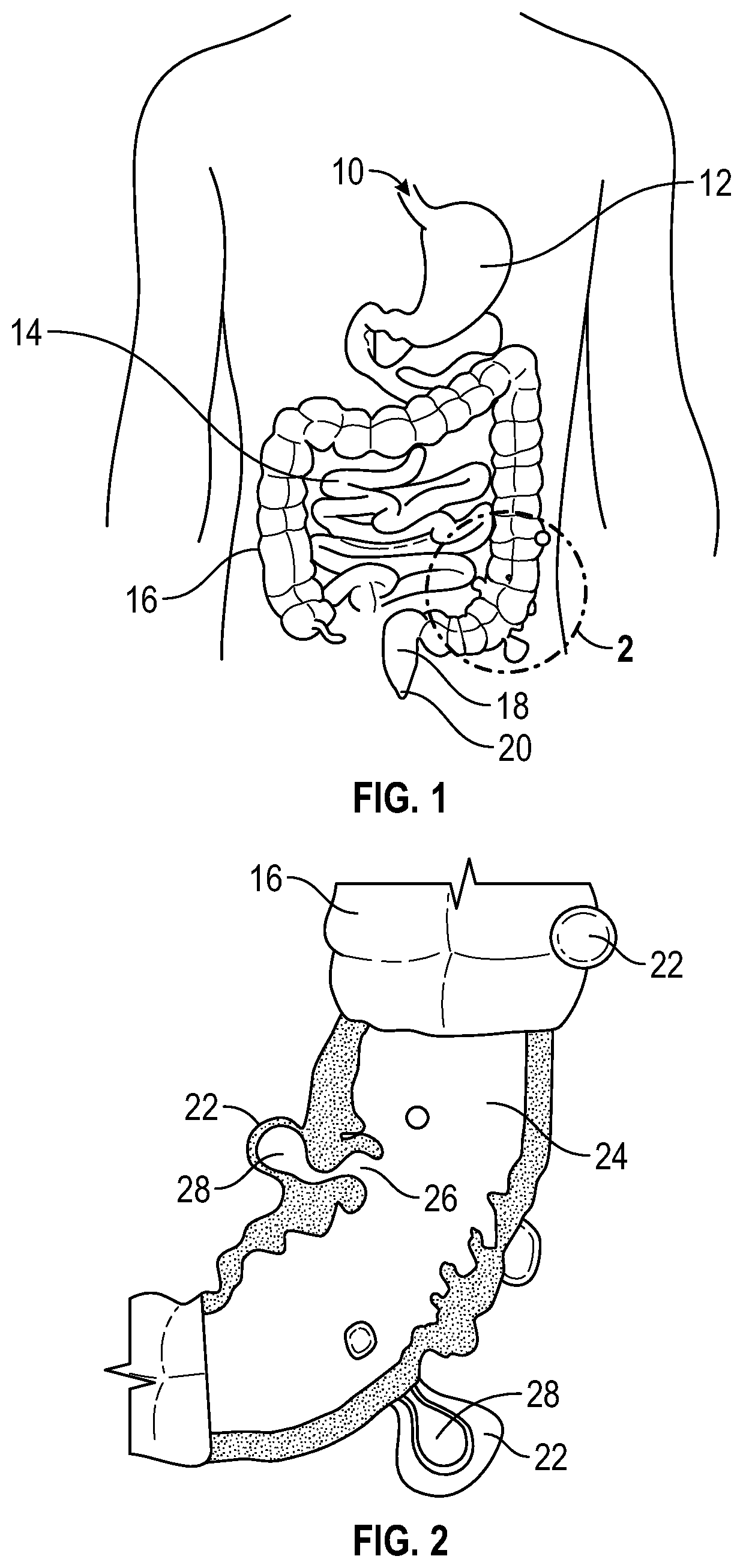 Patent US12569361 Figure 1 – Devices and methods to treat and prevent diverticulitis