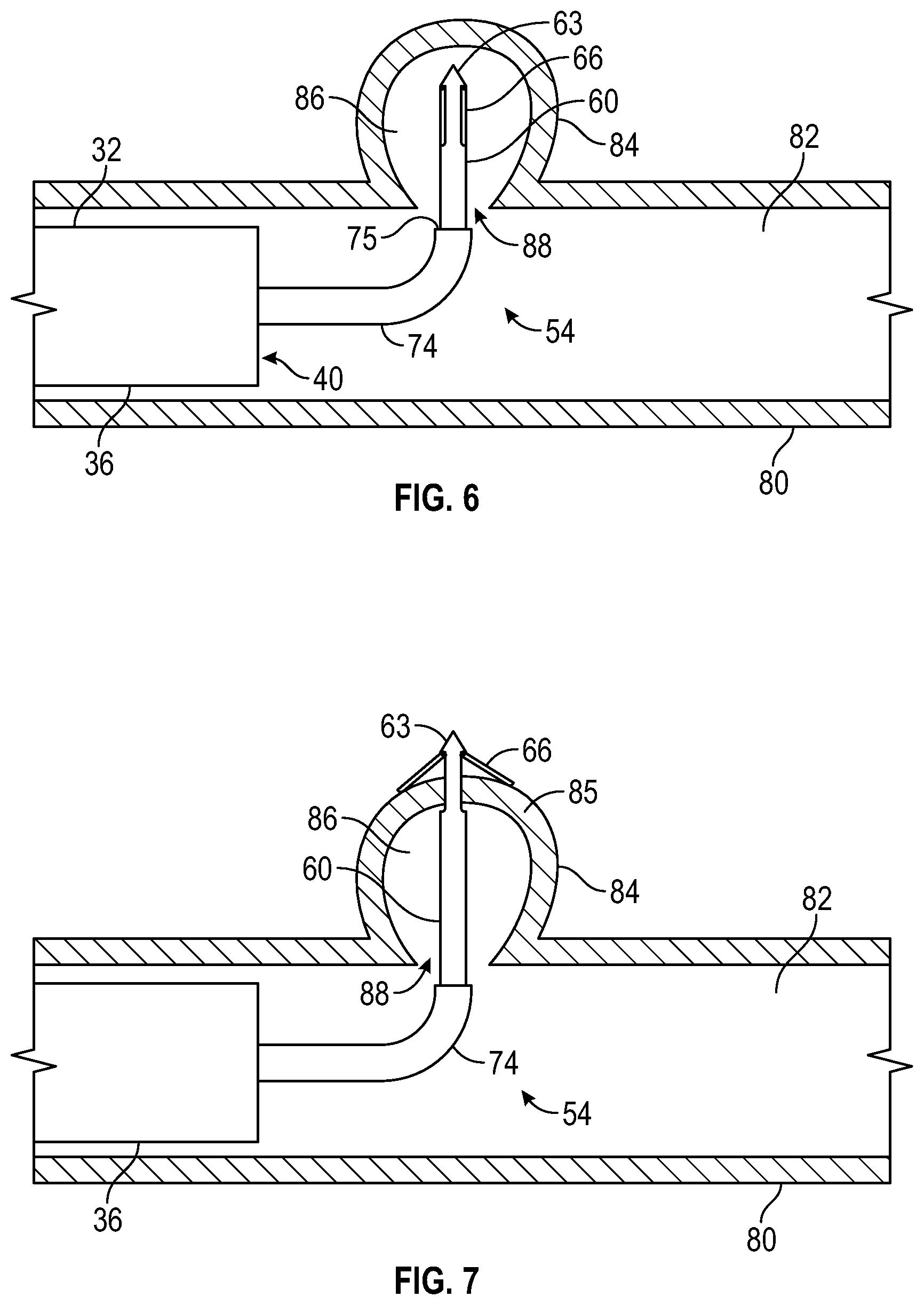 Patent US12569361 Figure 4 – Devices and methods to treat and prevent diverticulitis