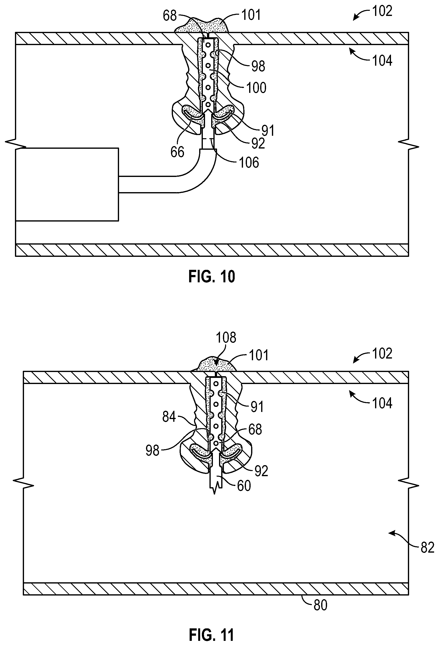 Patent US12569361 Figure 6 – Devices and methods to treat and prevent diverticulitis