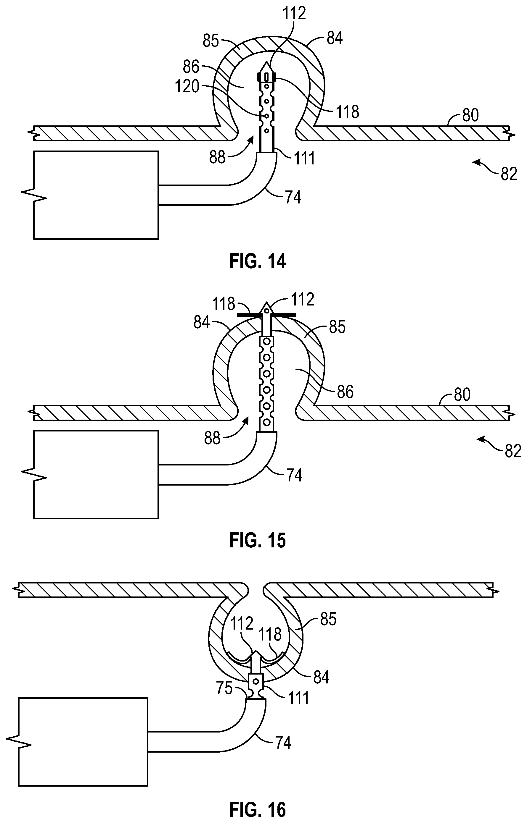 Patent US12569361 Figure 8 – Devices and methods to treat and prevent diverticulitis