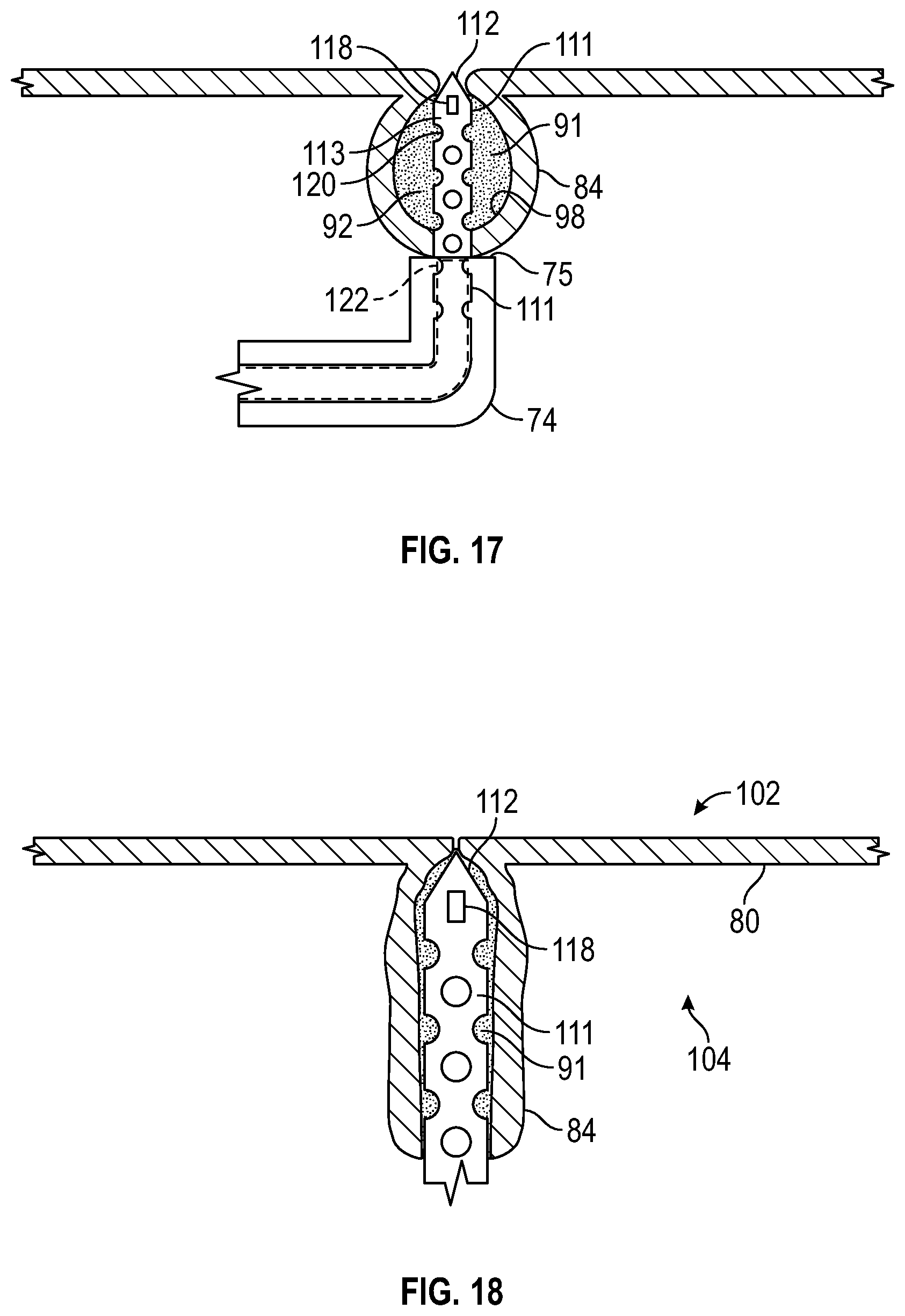 Patent US12569361 Figure 9 – Devices and methods to treat and prevent diverticulitis