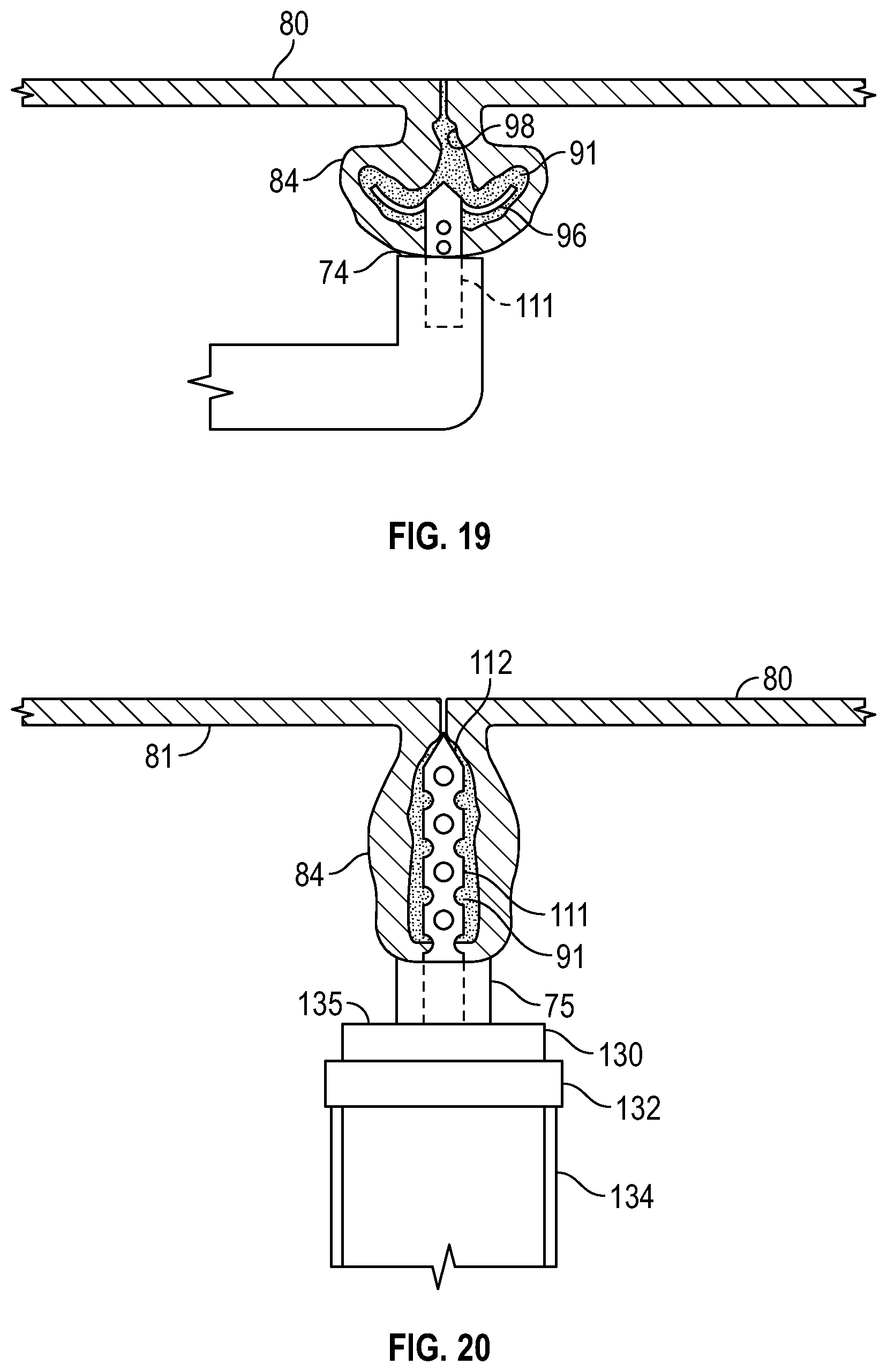 Patent US12569361 Figure 10 – Devices and methods to treat and prevent diverticulitis