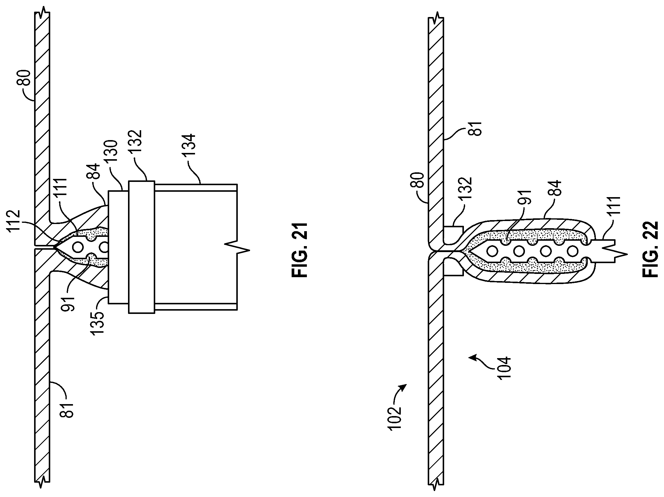 Patent US12569361 Figure 11 – Devices and methods to treat and prevent diverticulitis