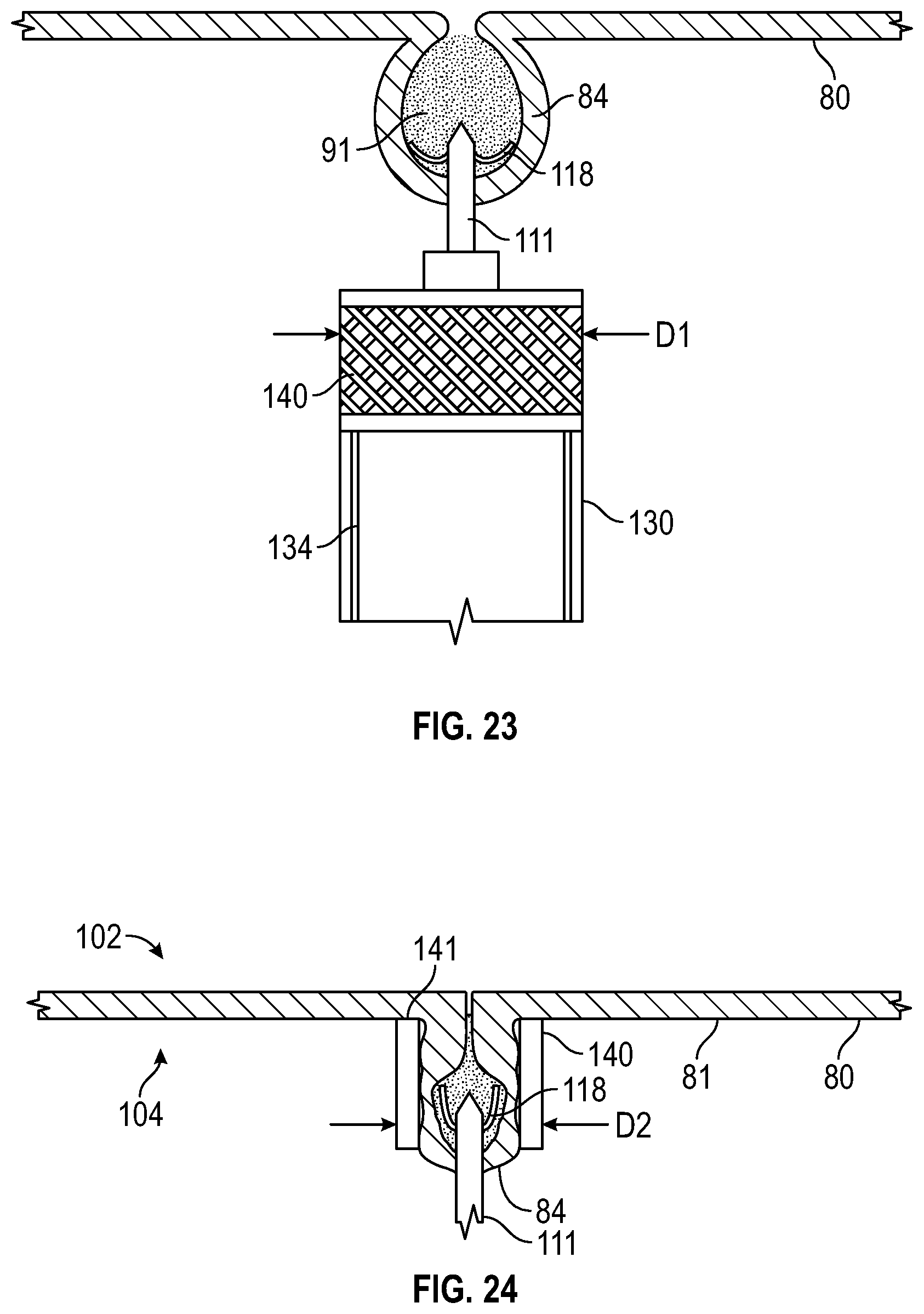 Patent US12569361 Figure 12 – Devices and methods to treat and prevent diverticulitis