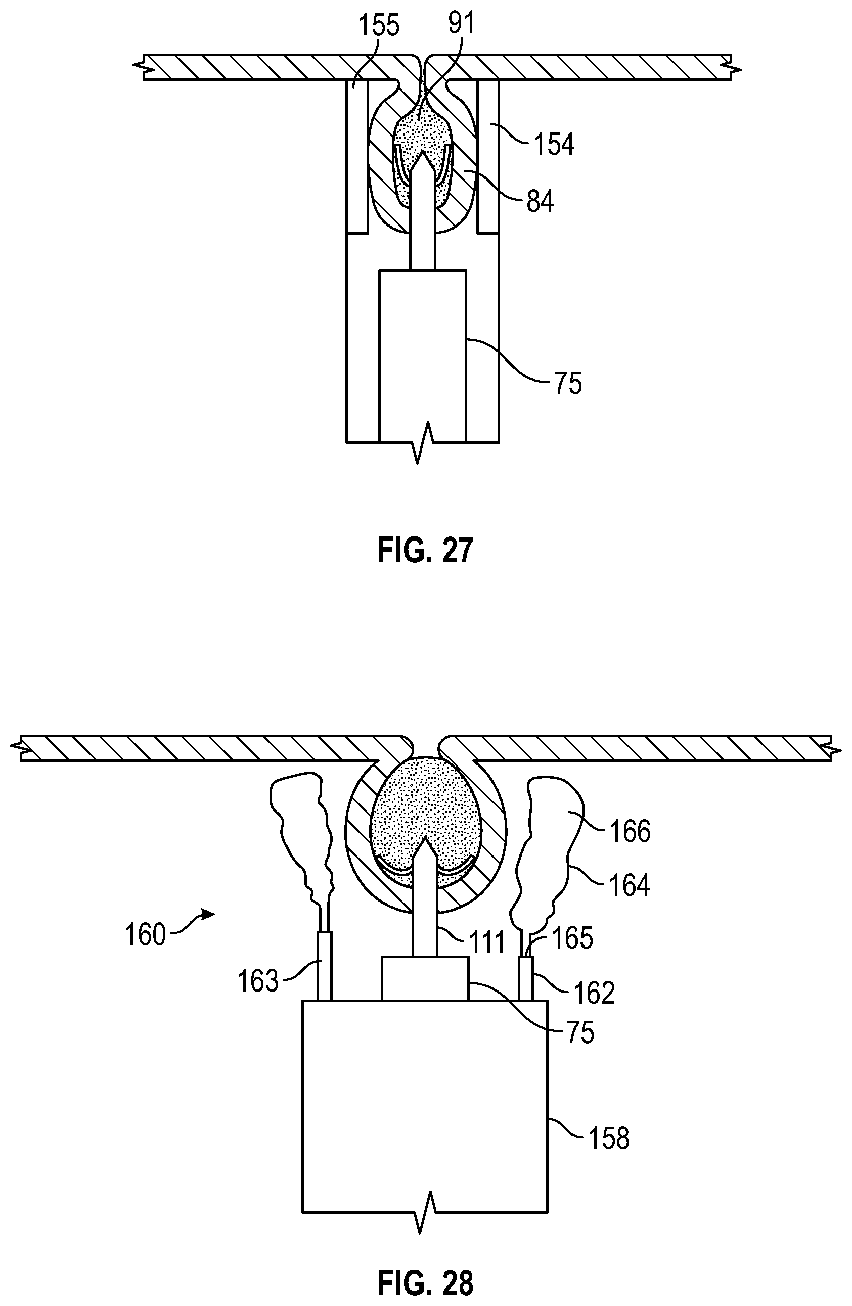 Patent US12569361 Figure 14 – Devices and methods to treat and prevent diverticulitis