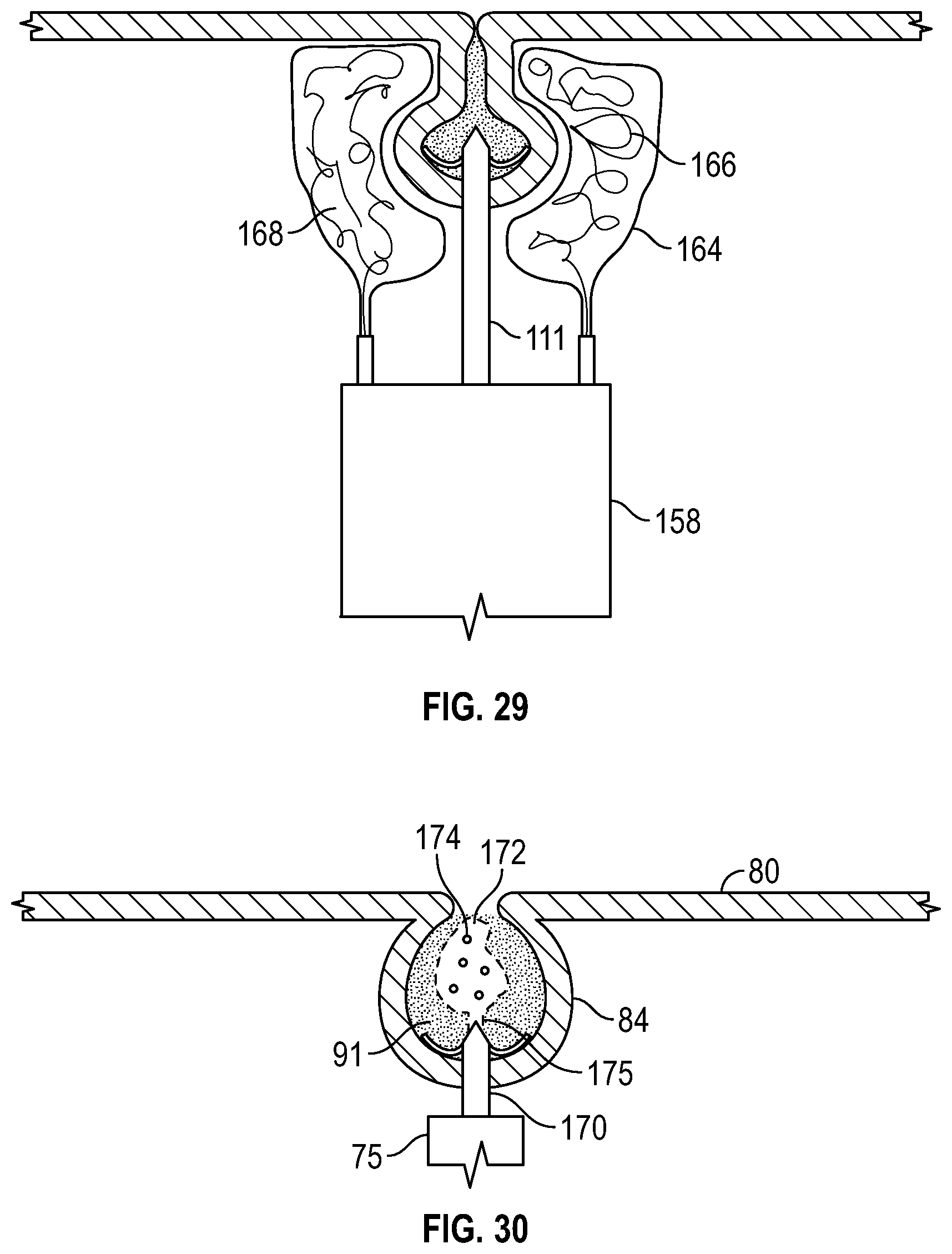 Patent US12569361 Figure 15 – Devices and methods to treat and prevent diverticulitis