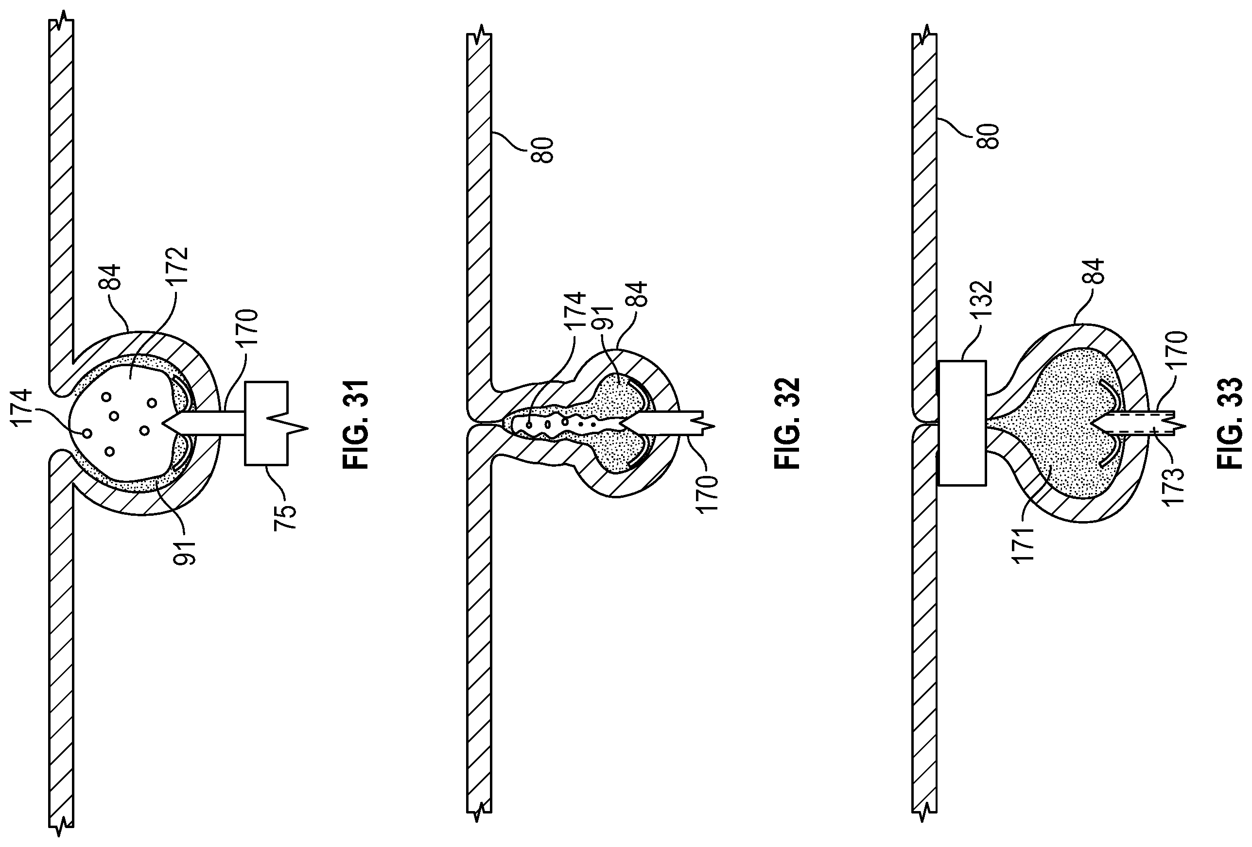 Patent US12569361 Figure 16 – Devices and methods to treat and prevent diverticulitis
