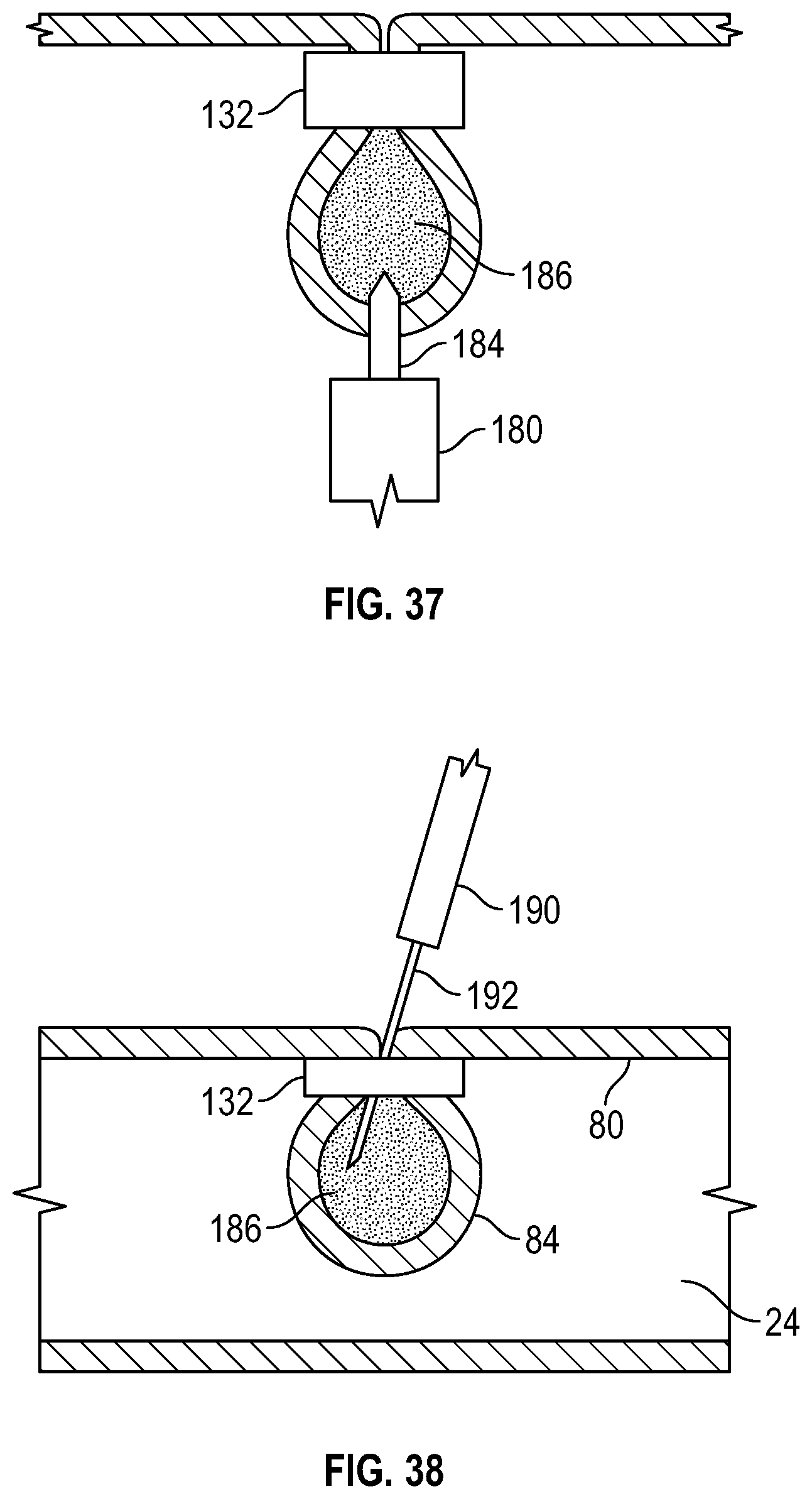 Patent US12569361 Figure 18 – Devices and methods to treat and prevent diverticulitis