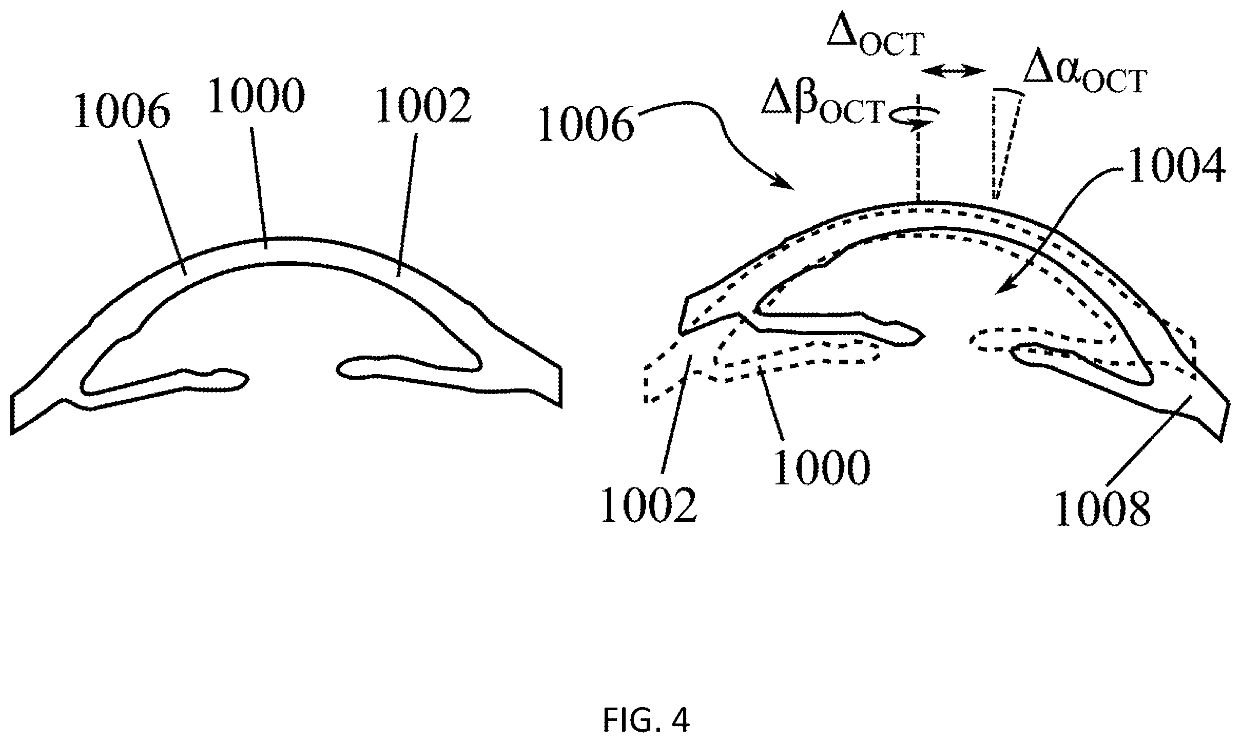 Patent US12569369 Figure 4 – System for laser-based ametropia correction, and method for the alignment thereof