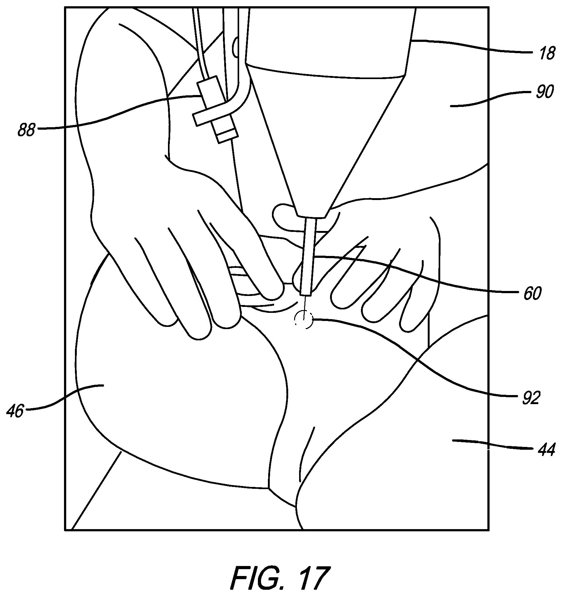 Patent US12569390 Figure 11 – Percussive adjusting instrument