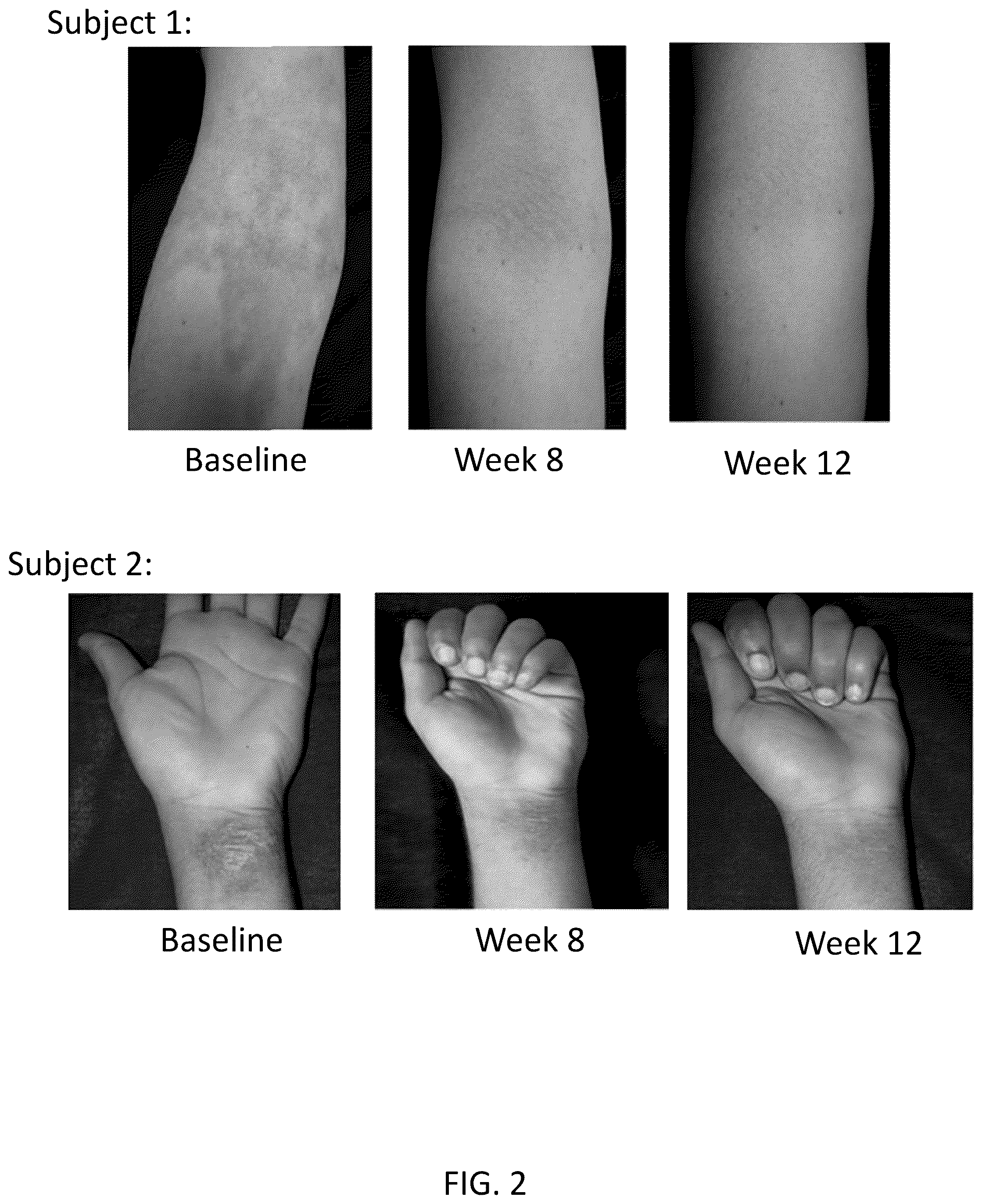 Patent US12569453 Figure 2 – Use of tapinarof for the treatment of atopic dermatitis