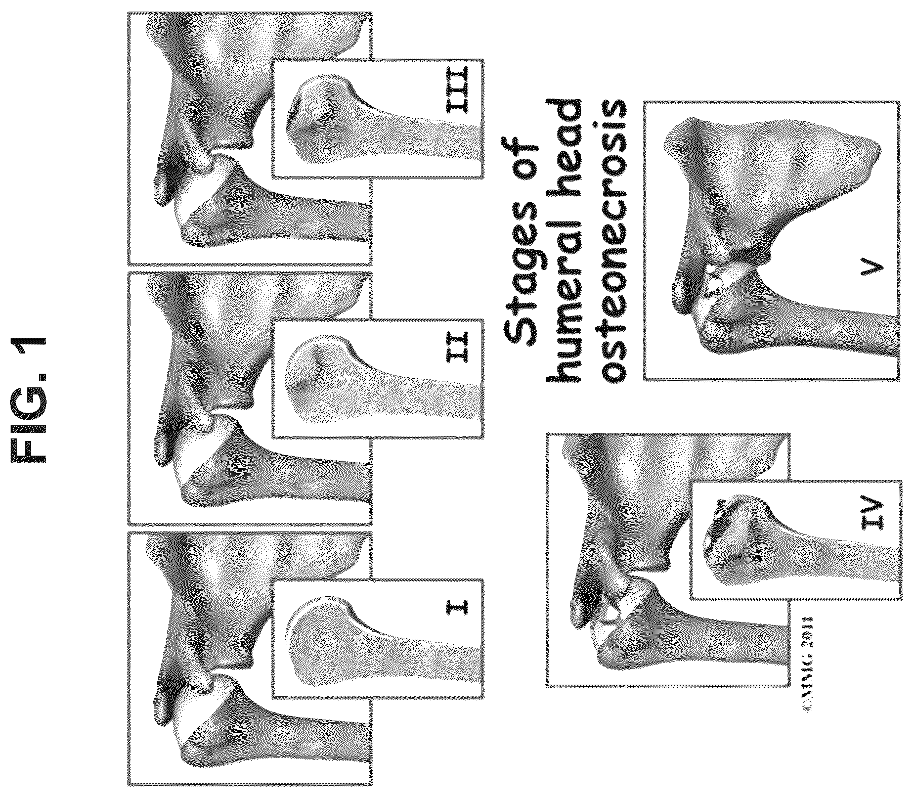 Patent US12569506 Figure 1 – Methods of treating osteonecrosis with LLP2A-bisphosphonate compounds