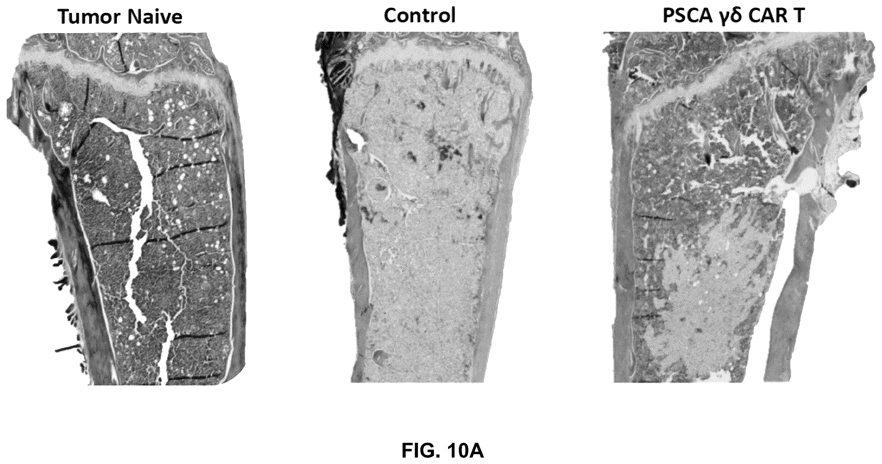 Patent US12569507 Figure 20 – CAR T-cells for the treatment of bone metastatic cancer
