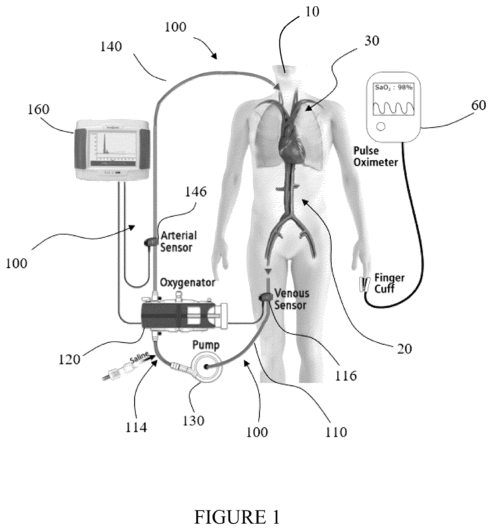 Patent US12569600 Figure 1 – Method and apparatus for assessing cardiac output in veno-venous extracorporeal blood oxygenation