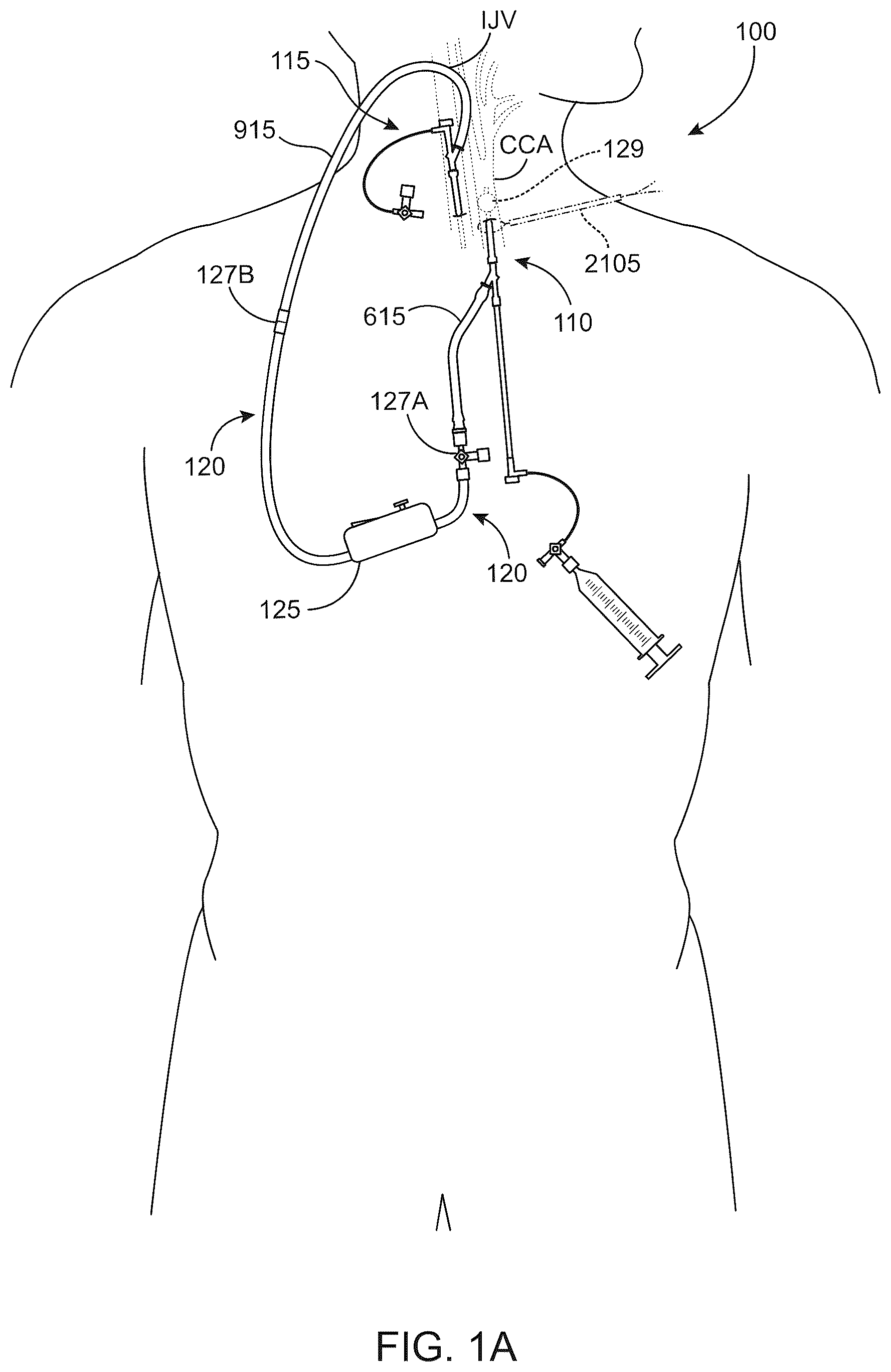 Patent US12569607 — Embolic protection in connection with transcarotid carotid artery revascularization — Figure 1