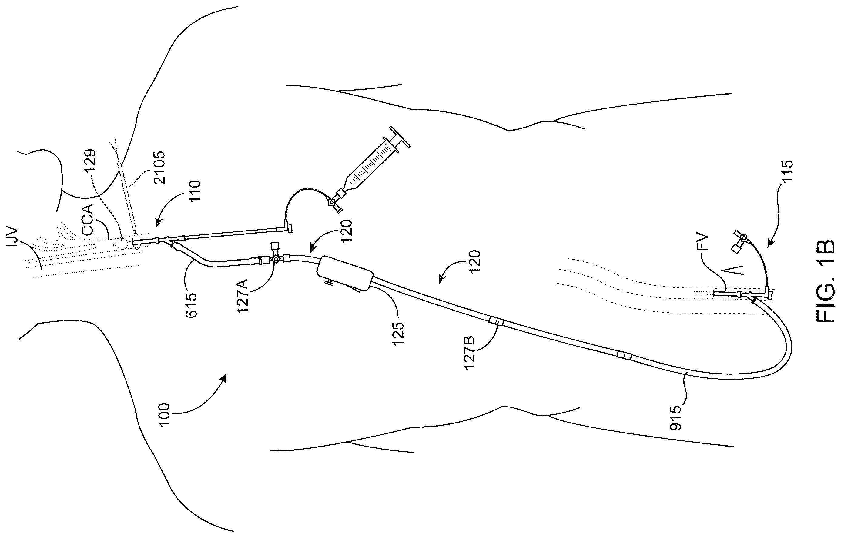 Patent US12569607 Figure 2 – Embolic protection in connection with transcarotid carotid artery revascularization