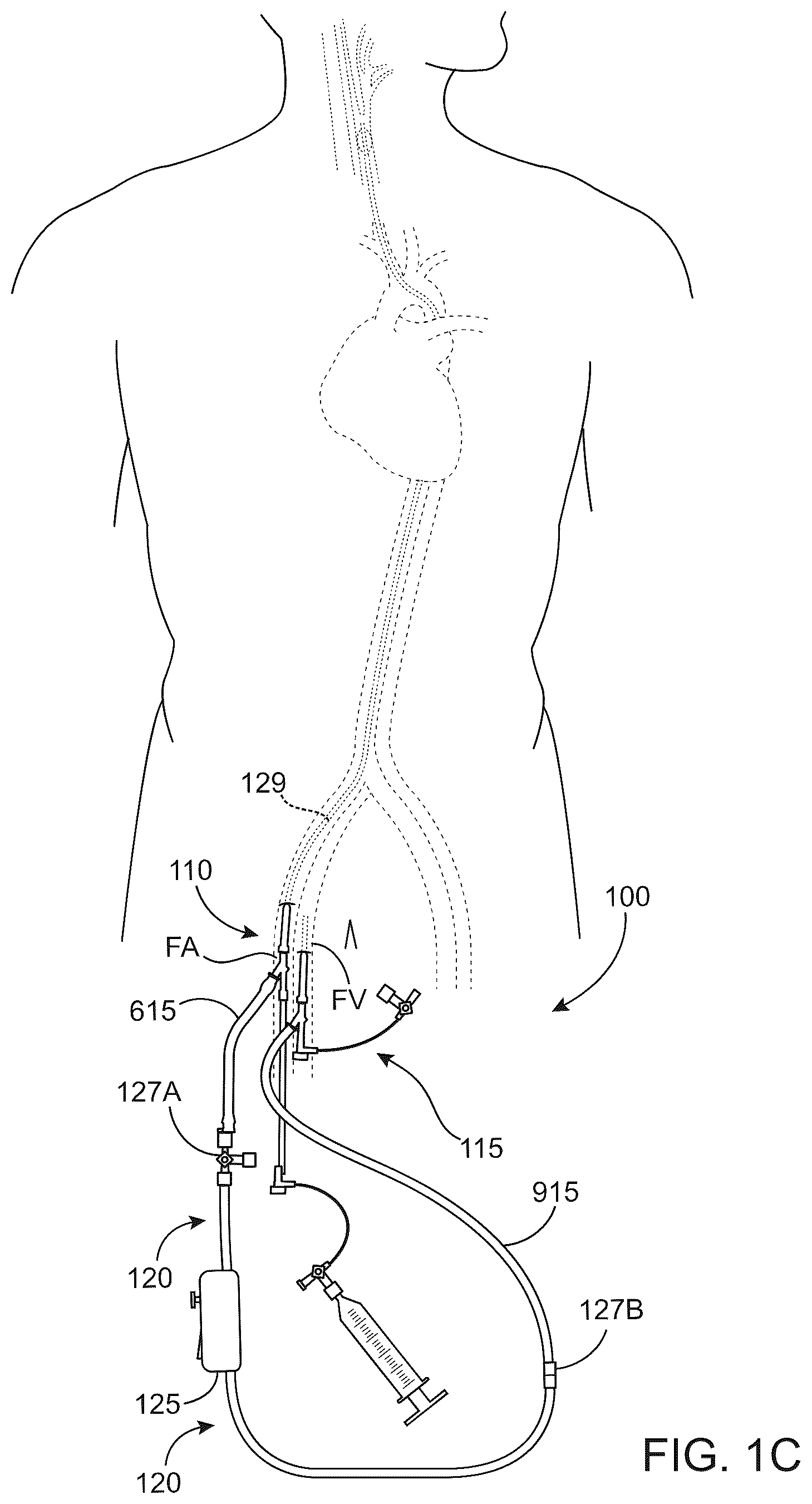 Patent US12569607 Figure 3 – Embolic protection in connection with transcarotid carotid artery revascularization