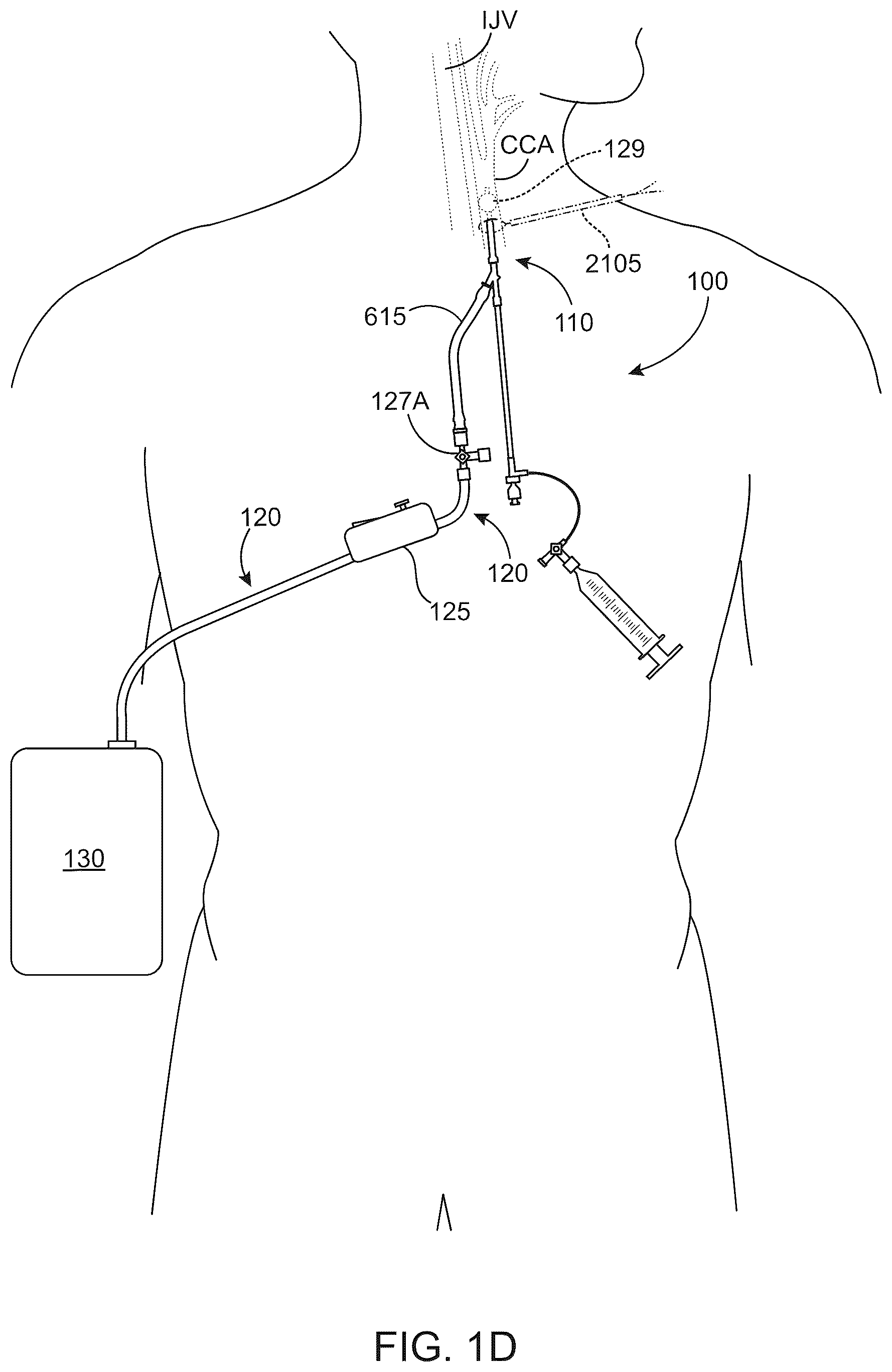 Patent US12569607 Figure 4 – Embolic protection in connection with transcarotid carotid artery revascularization