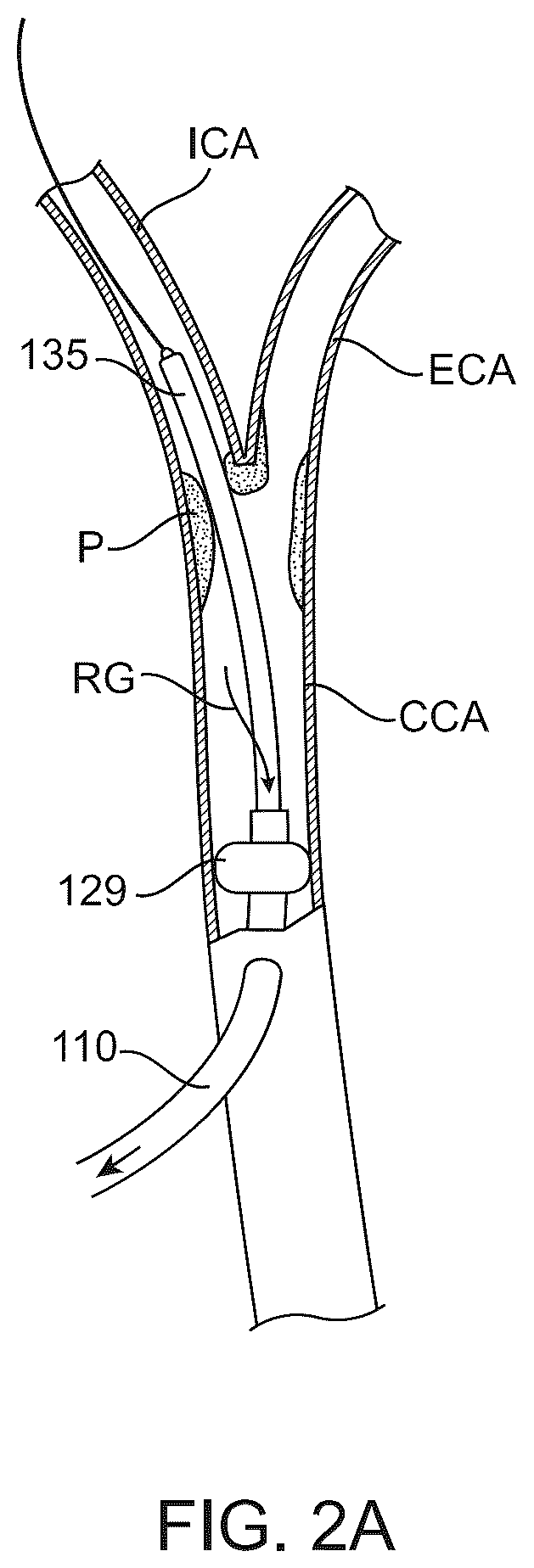 Patent US12569607 Figure 5 – Embolic protection in connection with transcarotid carotid artery revascularization