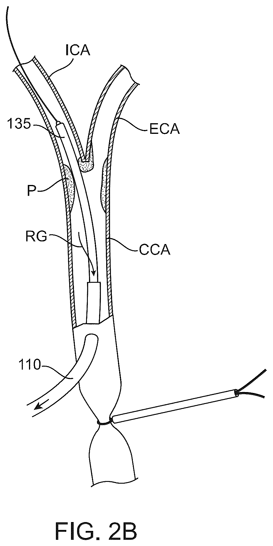 Patent US12569607 Figure 6 – Embolic protection in connection with transcarotid carotid artery revascularization