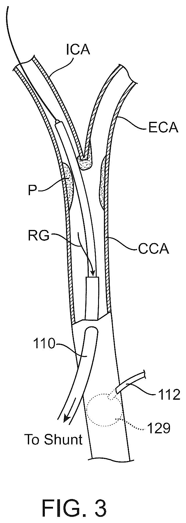 Patent US12569607 Figure 7 – Embolic protection in connection with transcarotid carotid artery revascularization