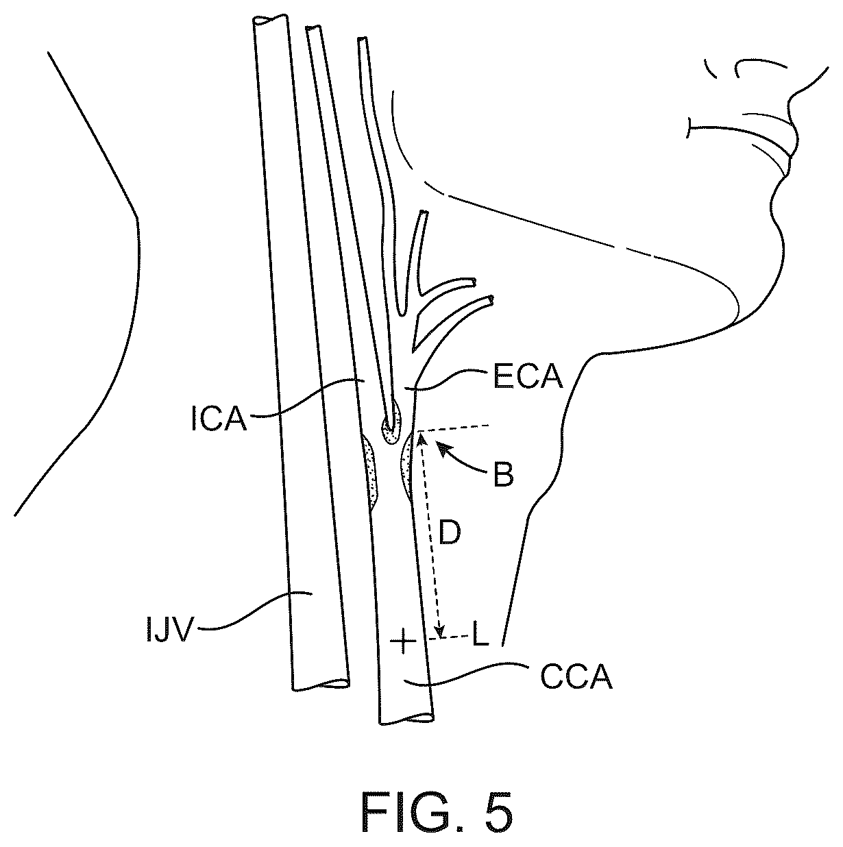 Patent US12569607 Figure 9 – Embolic protection in connection with transcarotid carotid artery revascularization