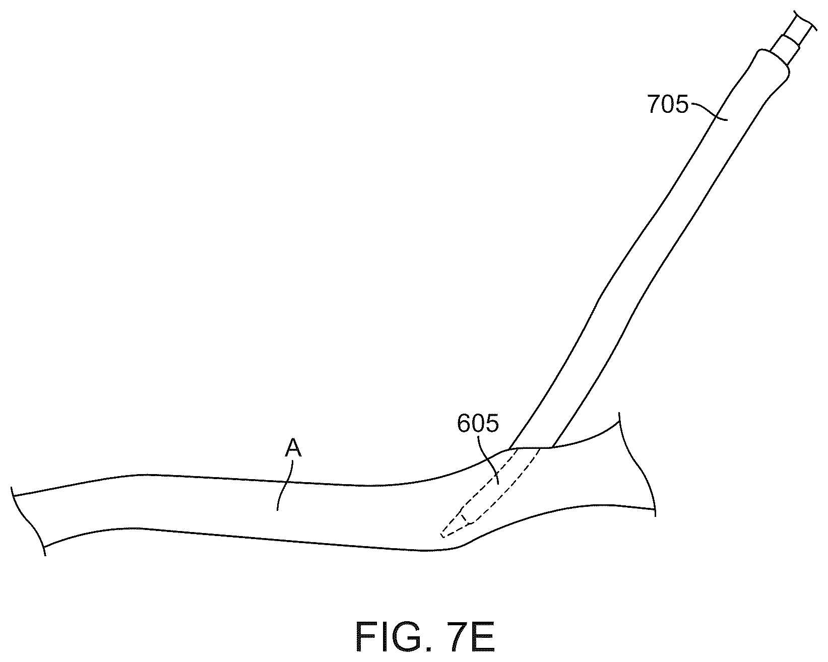 Patent US12569607 Figure 12 – Embolic protection in connection with transcarotid carotid artery revascularization