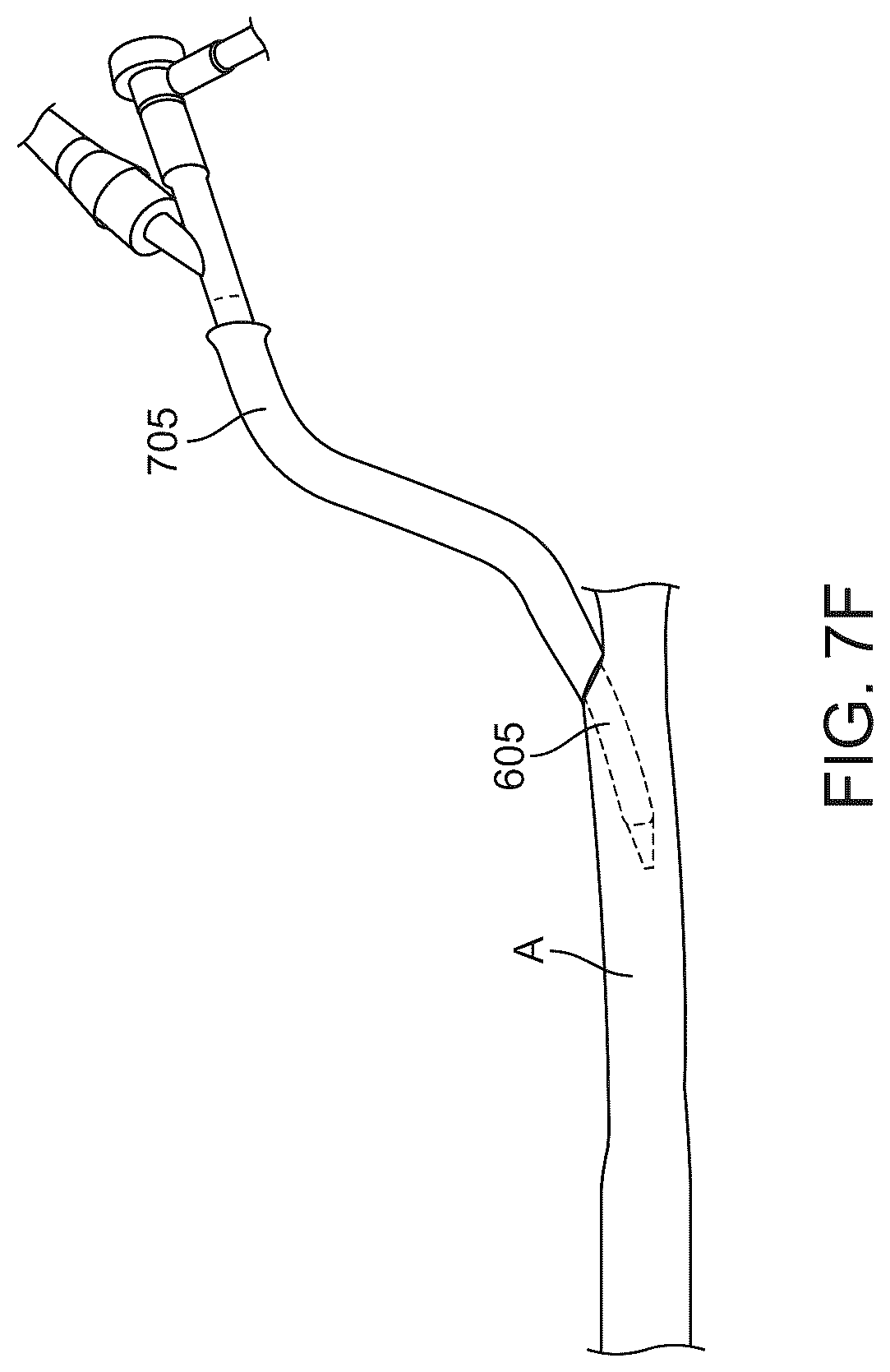 Patent US12569607 Figure 13 – Embolic protection in connection with transcarotid carotid artery revascularization