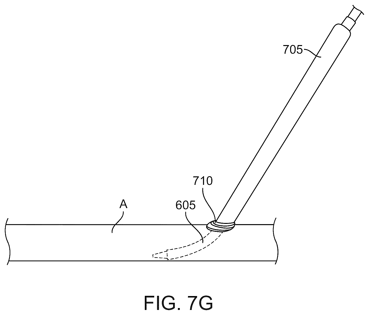 Patent US12569607 Figure 14 – Embolic protection in connection with transcarotid carotid artery revascularization