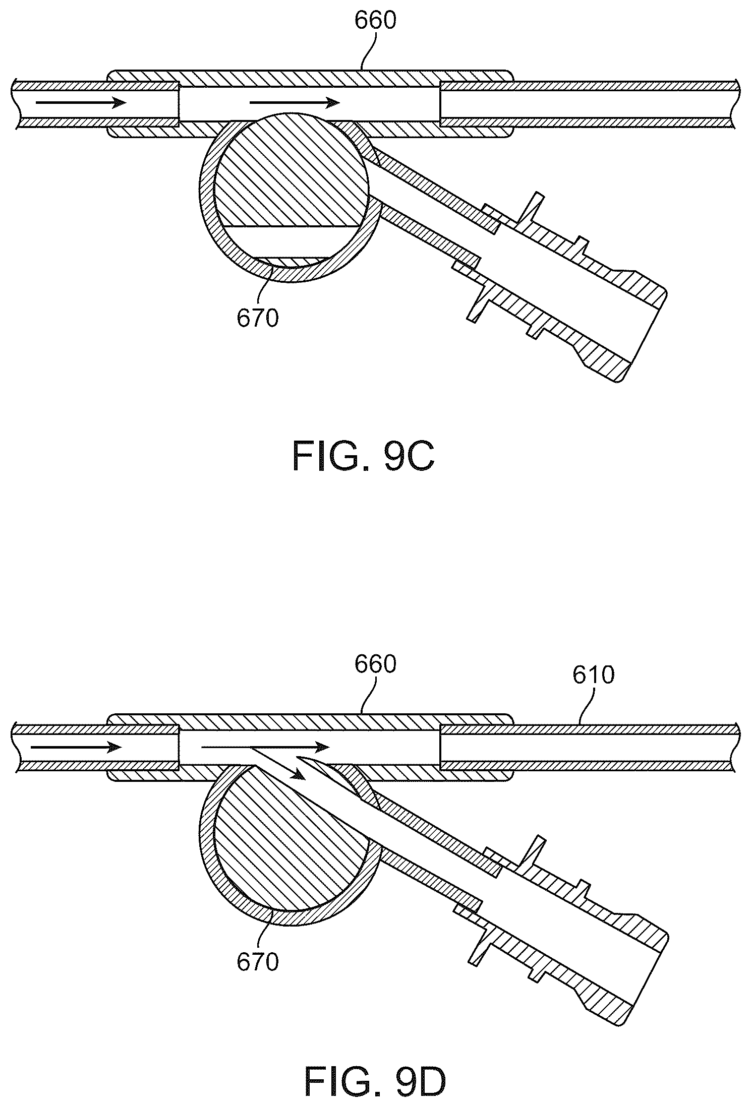 Patent US12569607 Figure 18 – Embolic protection in connection with transcarotid carotid artery revascularization