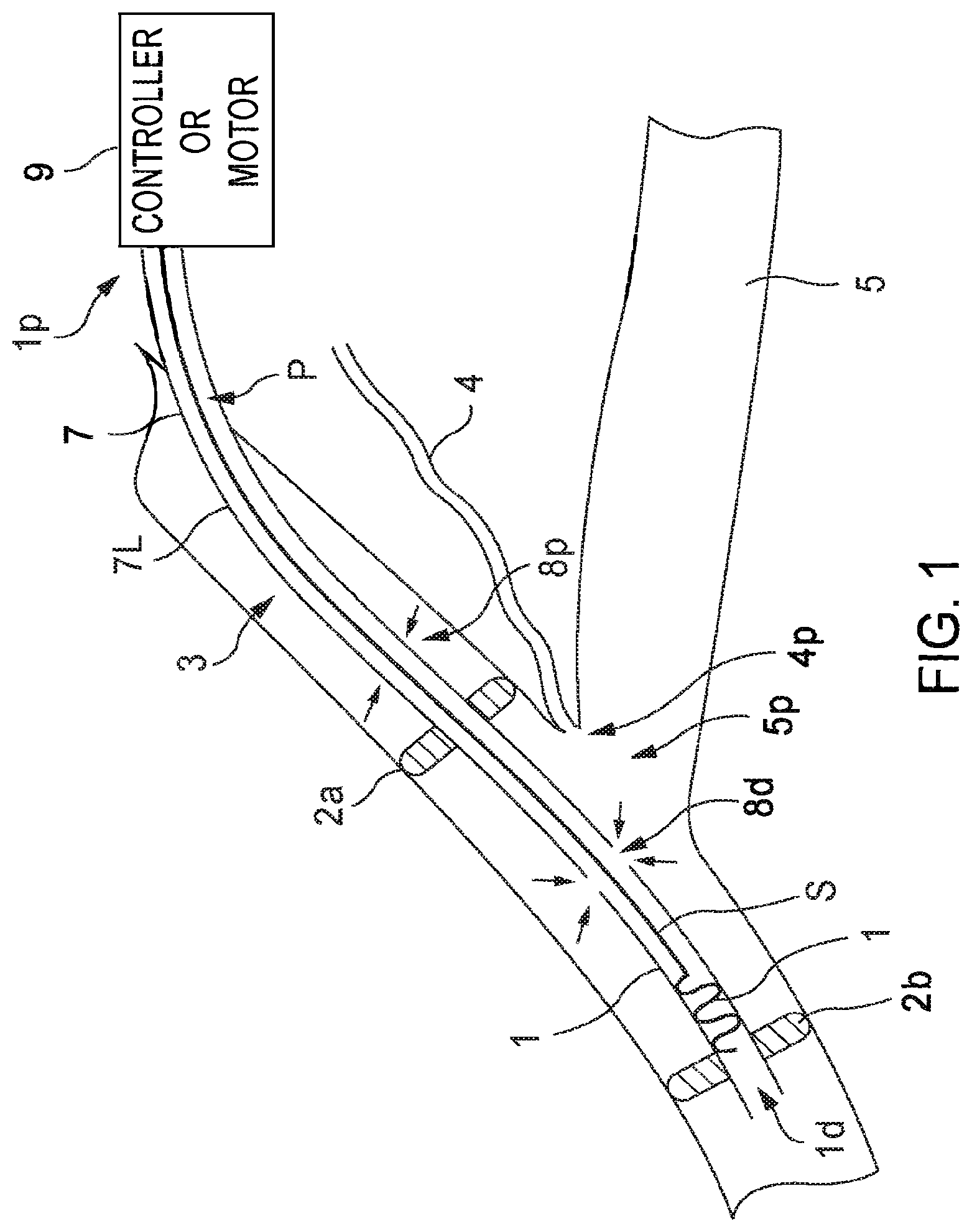 Patent US12569654 — Systems and methods for treatment of fluid overload — Figure 1