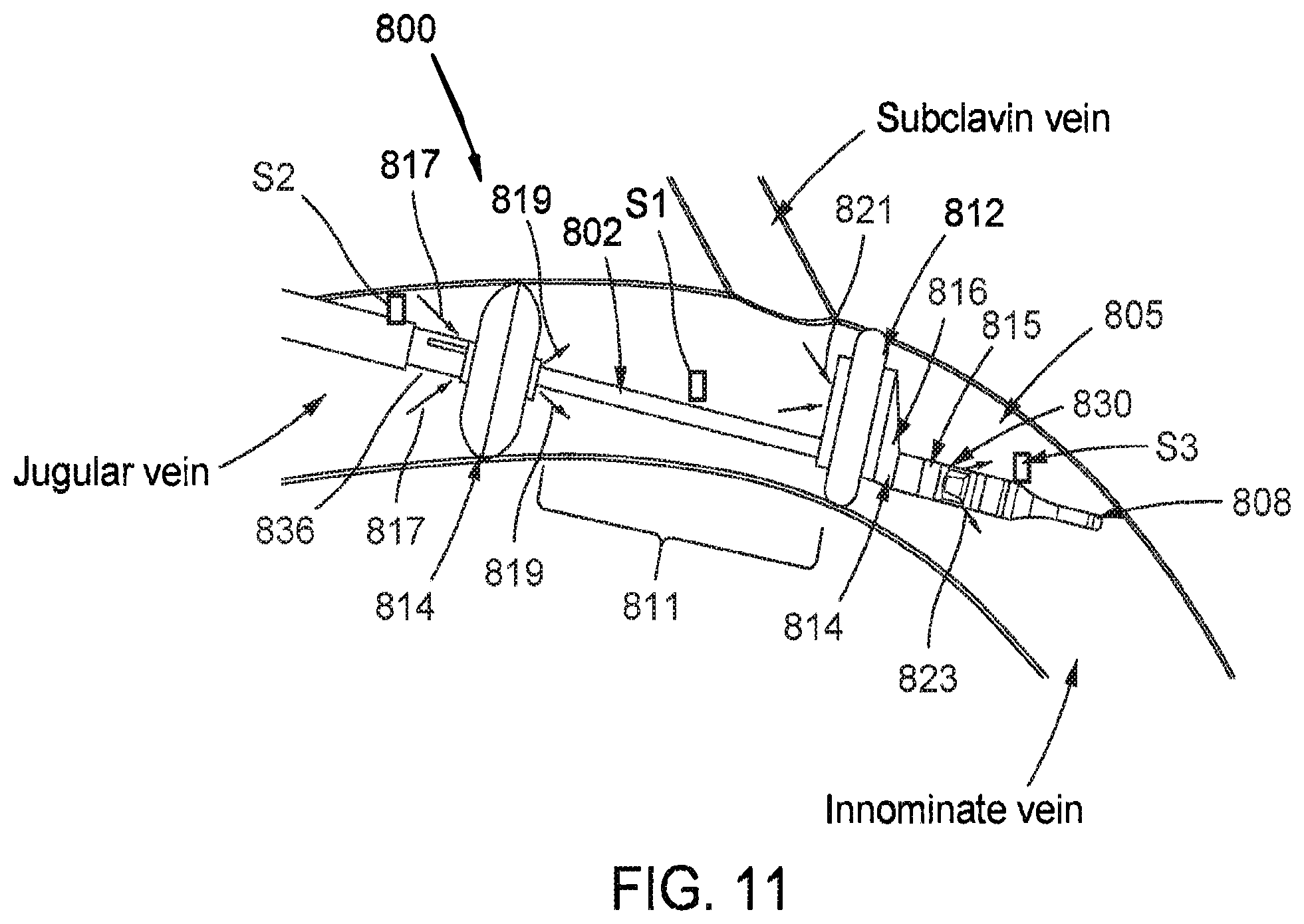 Patent US12569654 Figure 11 – Systems and methods for treatment of fluid overload