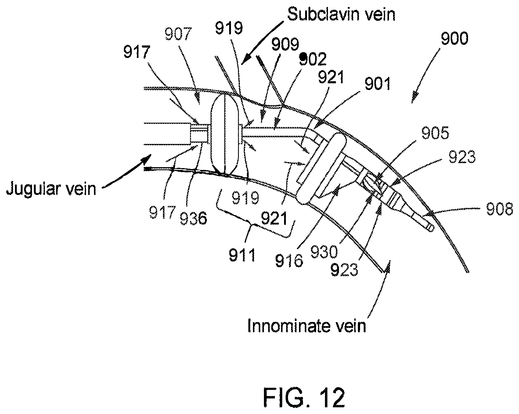Patent US12569654 Figure 12 – Systems and methods for treatment of fluid overload