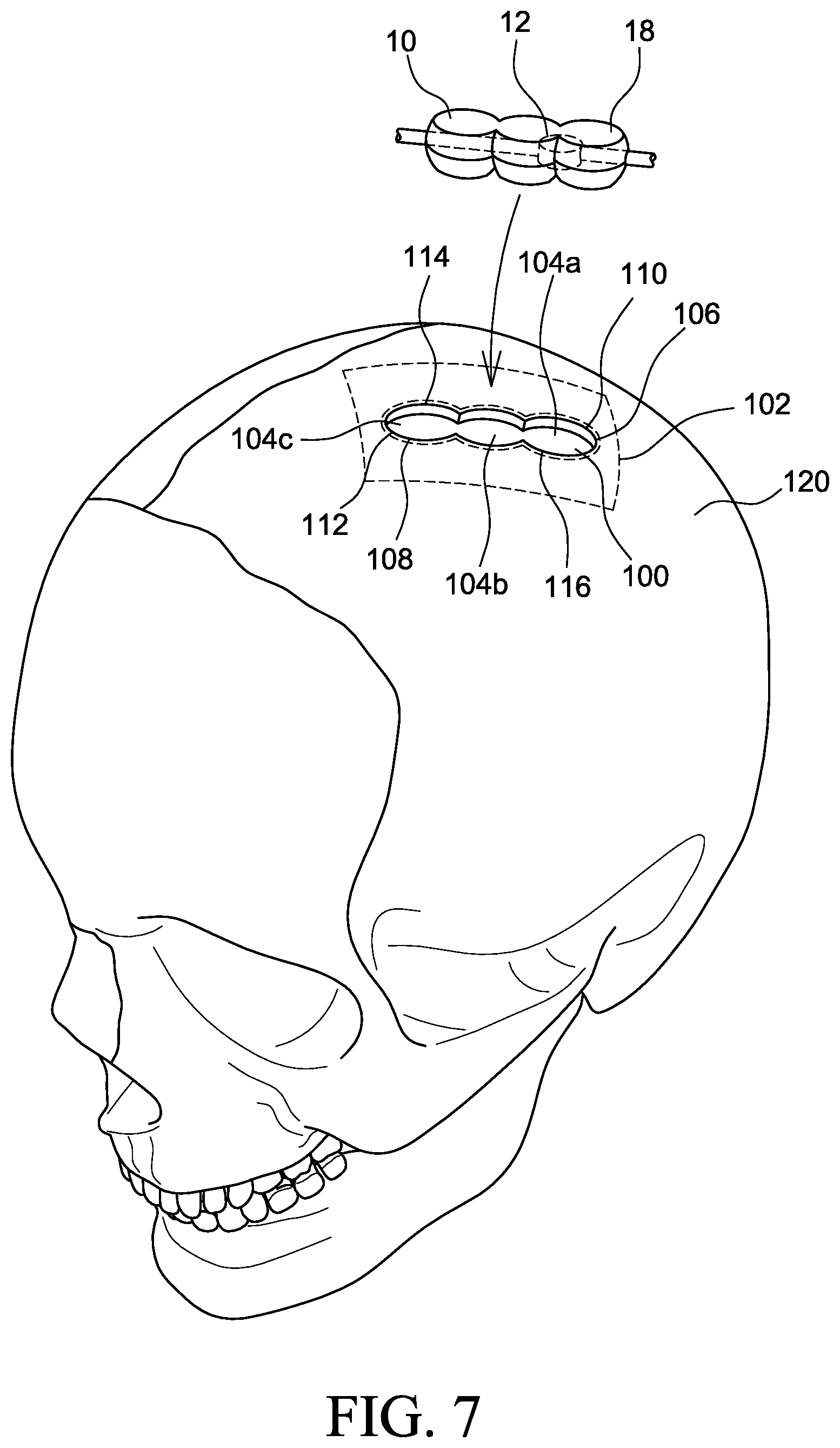 Patent US12569655 Figure 4 – Cerebral spinal fluid shunt plug