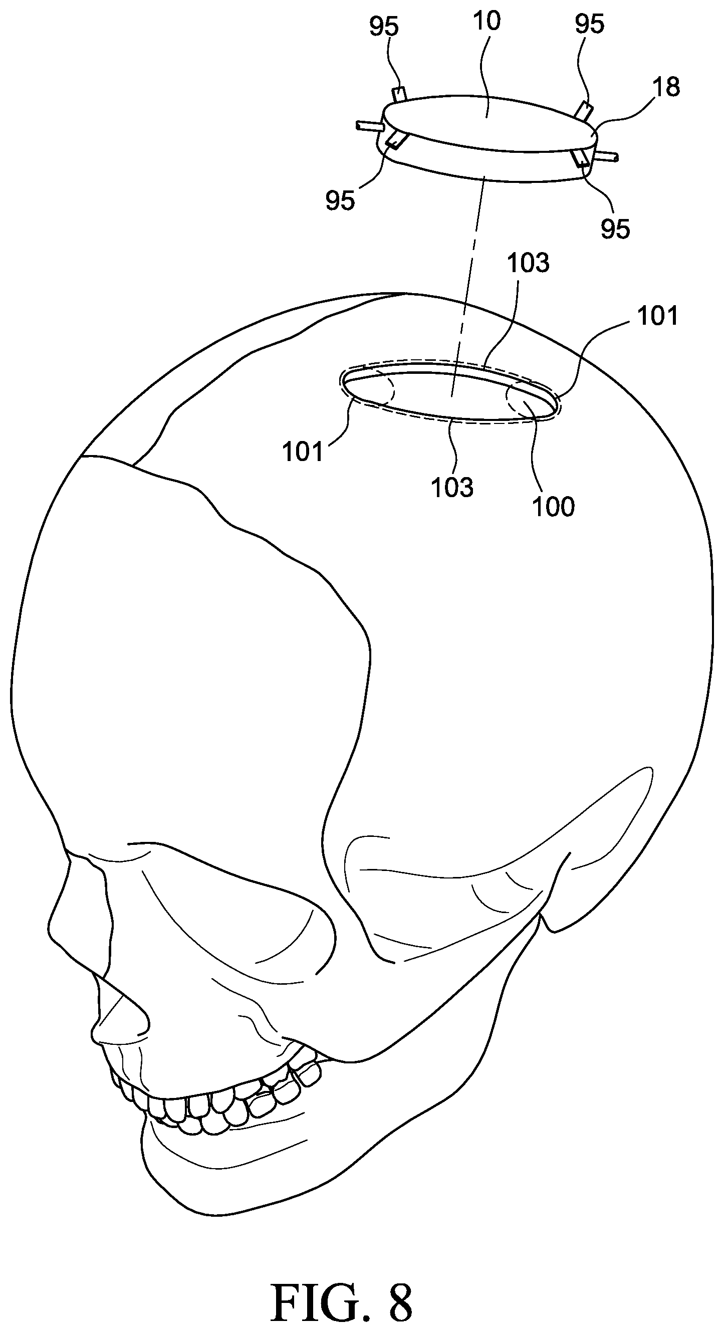 Patent US12569655 Figure 5 – Cerebral spinal fluid shunt plug