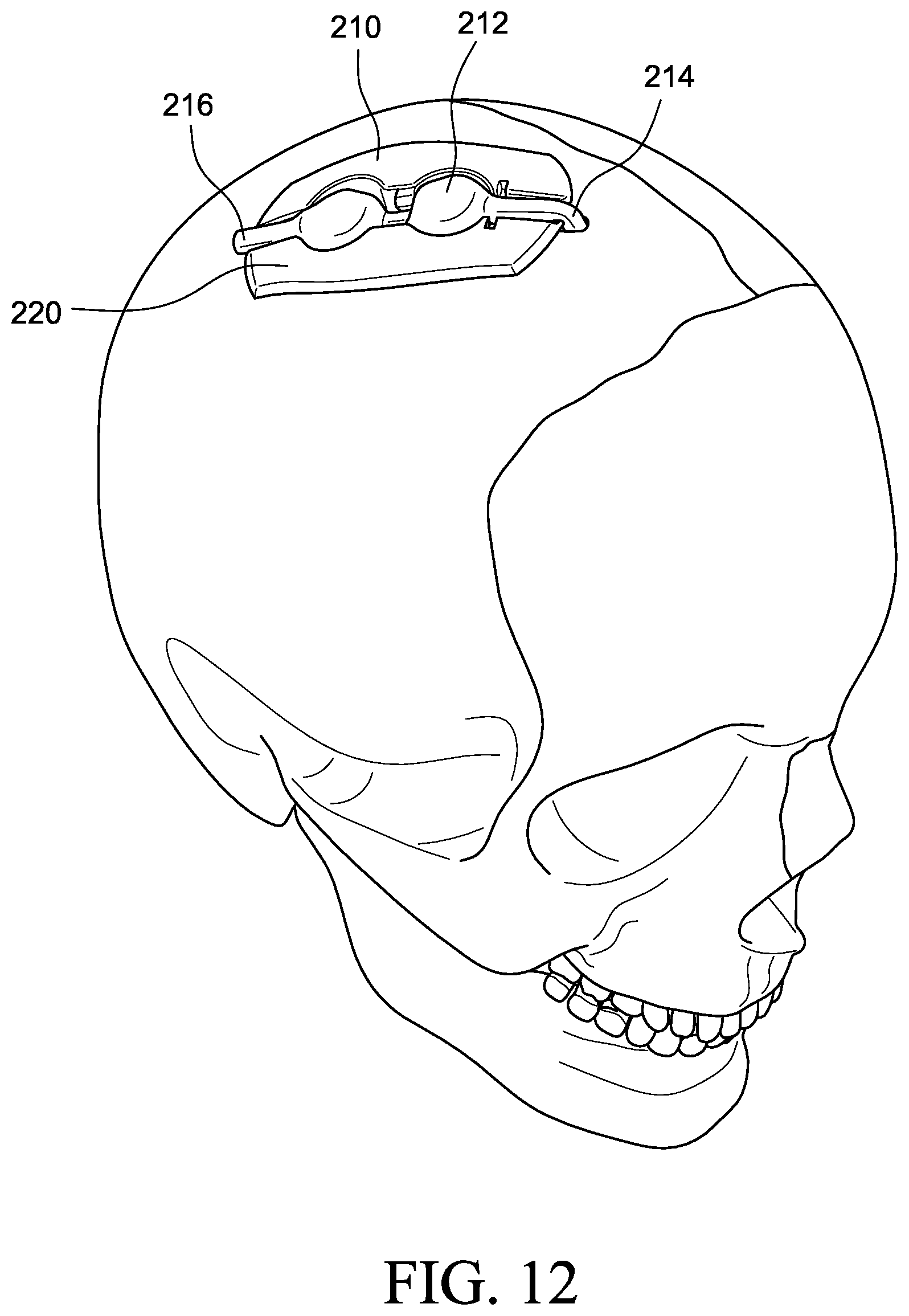 Patent US12569655 Figure 8 – Cerebral spinal fluid shunt plug
